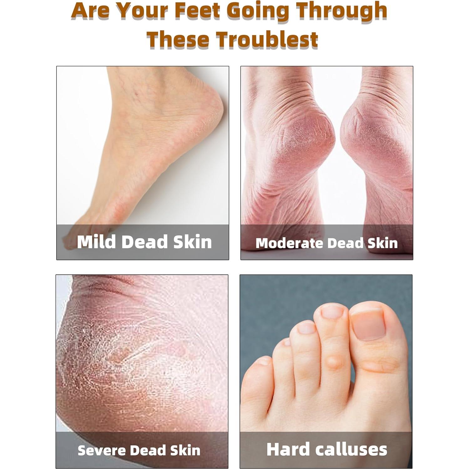 Removedor de Callos Dioche Acero Inoxidable Ergonómico Rosa