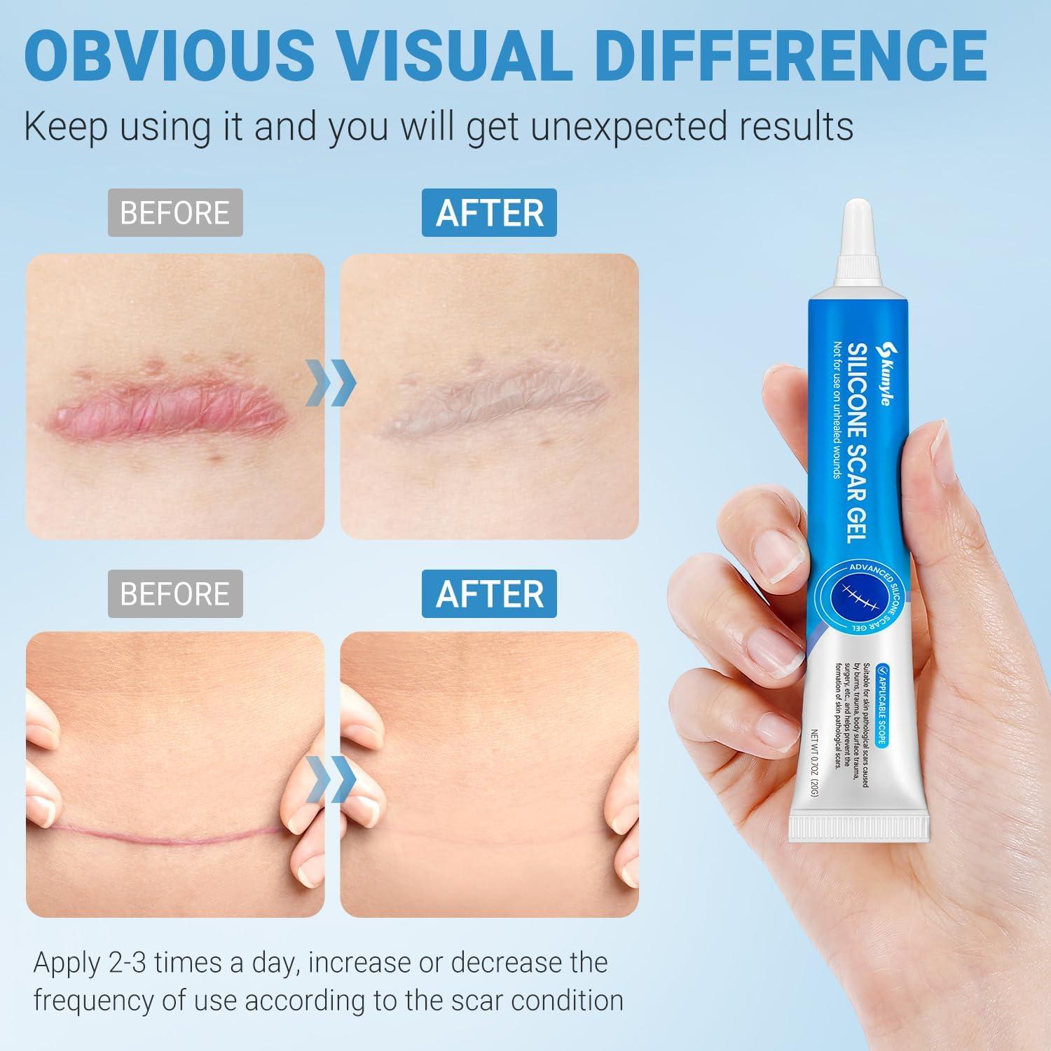 Gel de Cicatrices de Silicona Kunyle 20g - Eliminación de Cicatrices