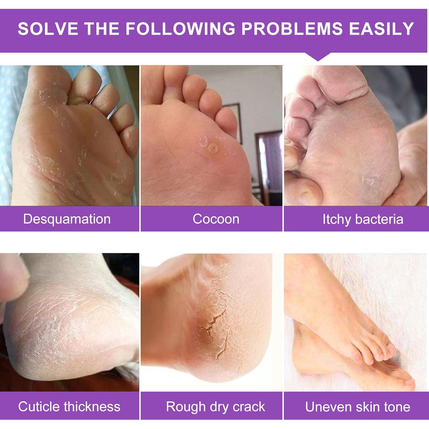 Mascarilla Exfoliante para Pies Wlytech - 5 Paquetes Hidratantes