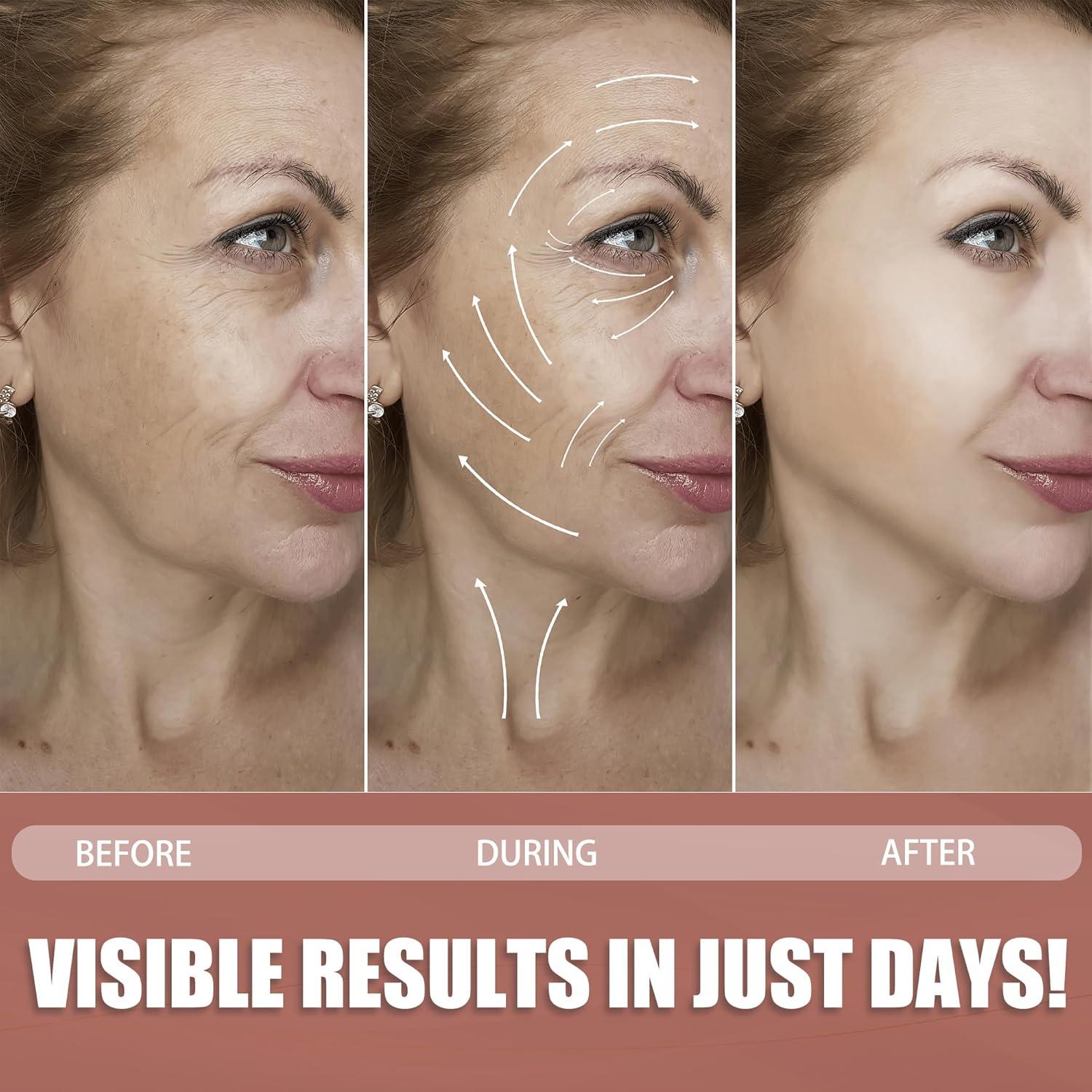 Cinta Facial Elevadora Antienvejecimiento Akissos - 2 Rollos