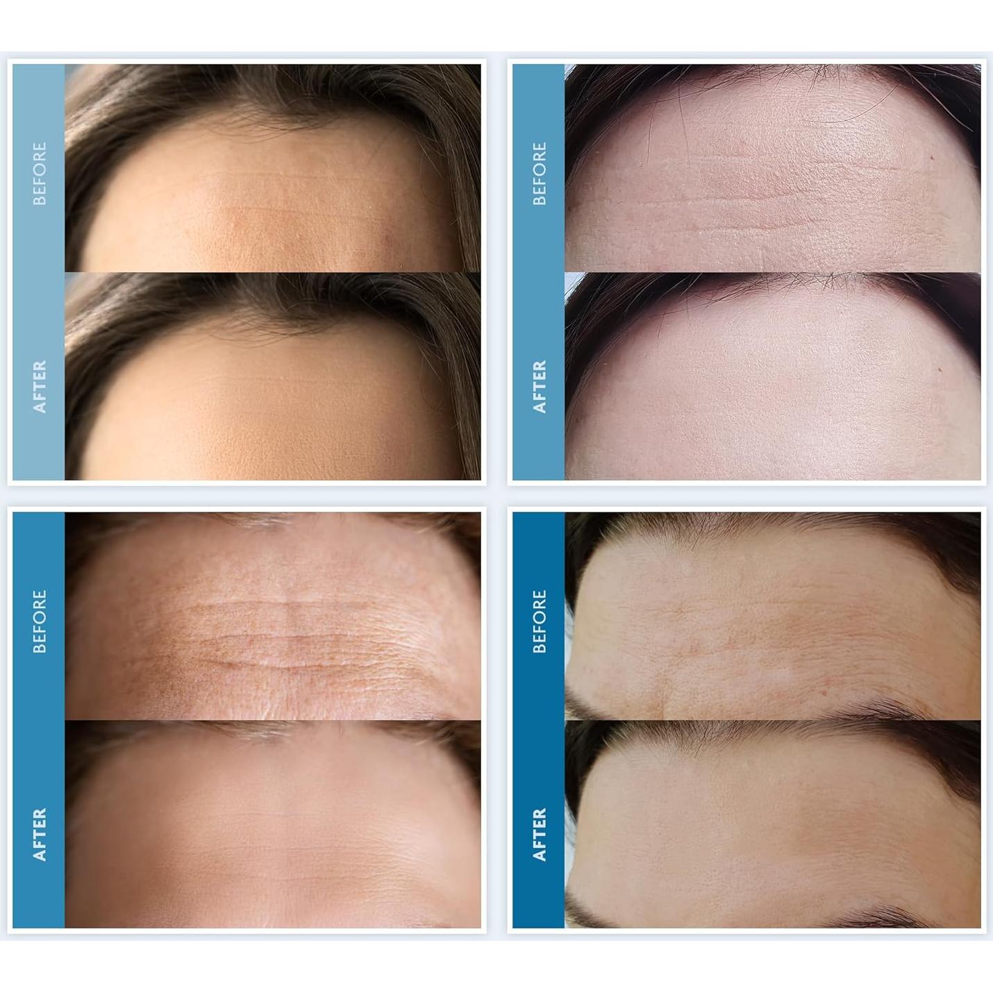 Parche de Silicona Antiarrugas Dersie - 3 Unidades Reutilizables