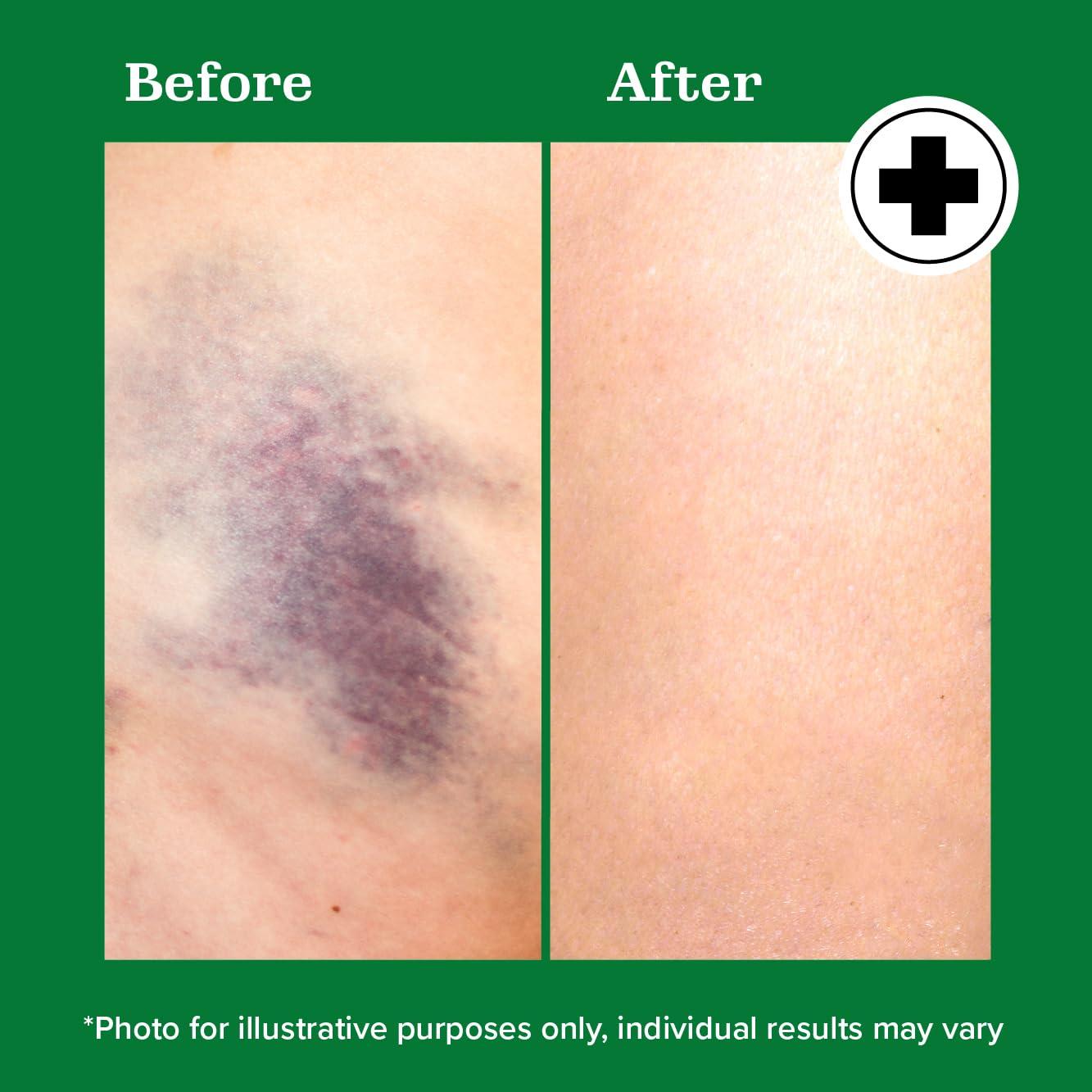 Gel Corporal para Moretones Miracle Plus Arnica 113.4 g