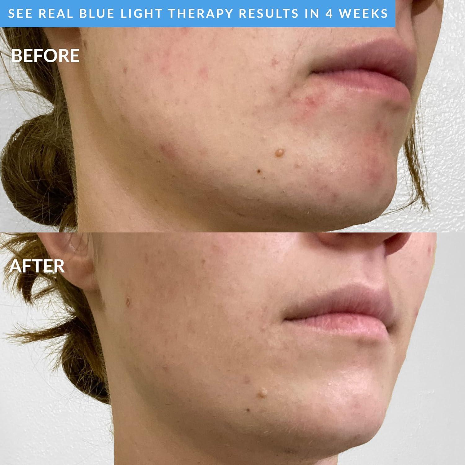 Cepillo Facial PMD Beauty - Limpieza Inteligente con Luz Azul