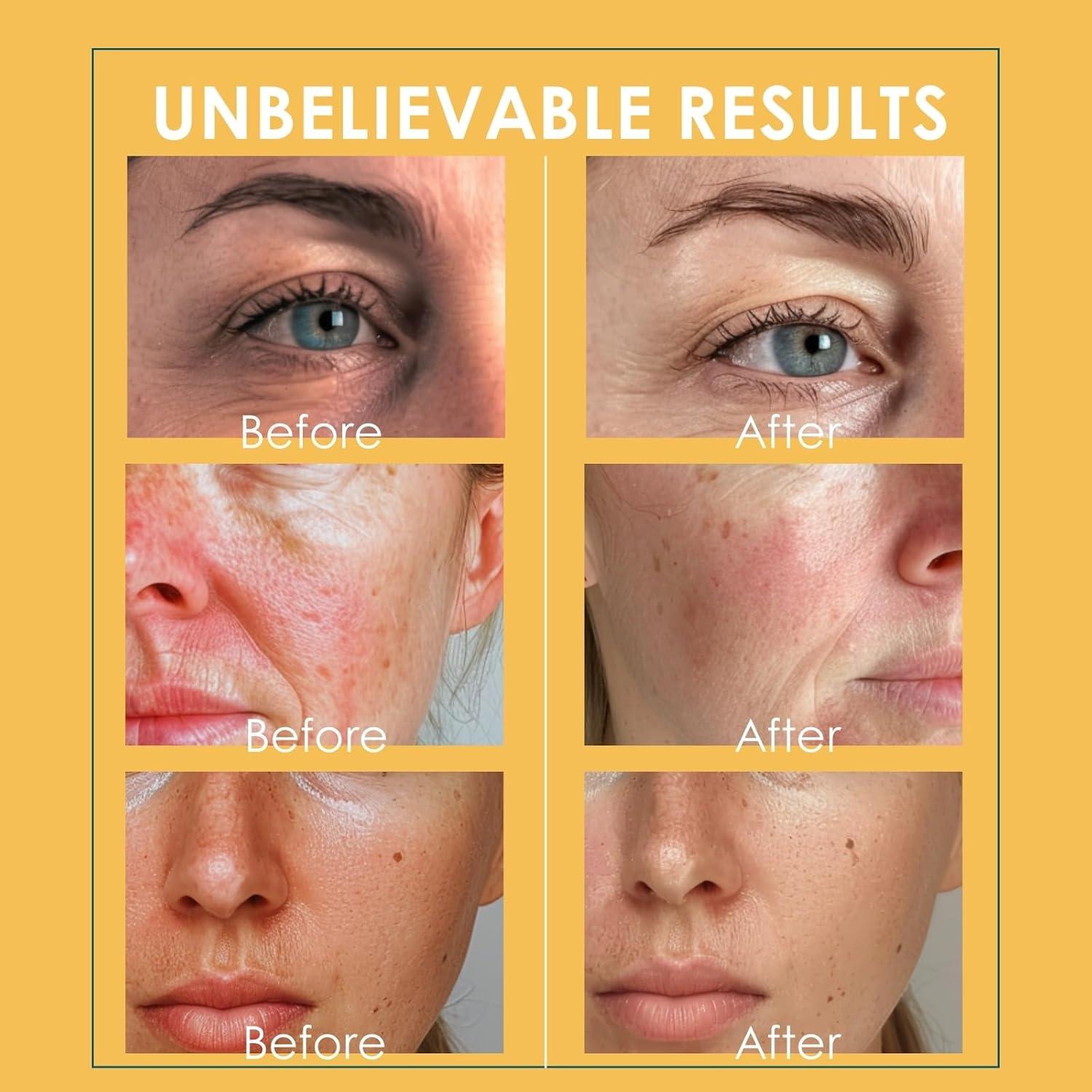 Esferas de Hielo Facial Lazzybeauty - Masajeador Frío para Piel