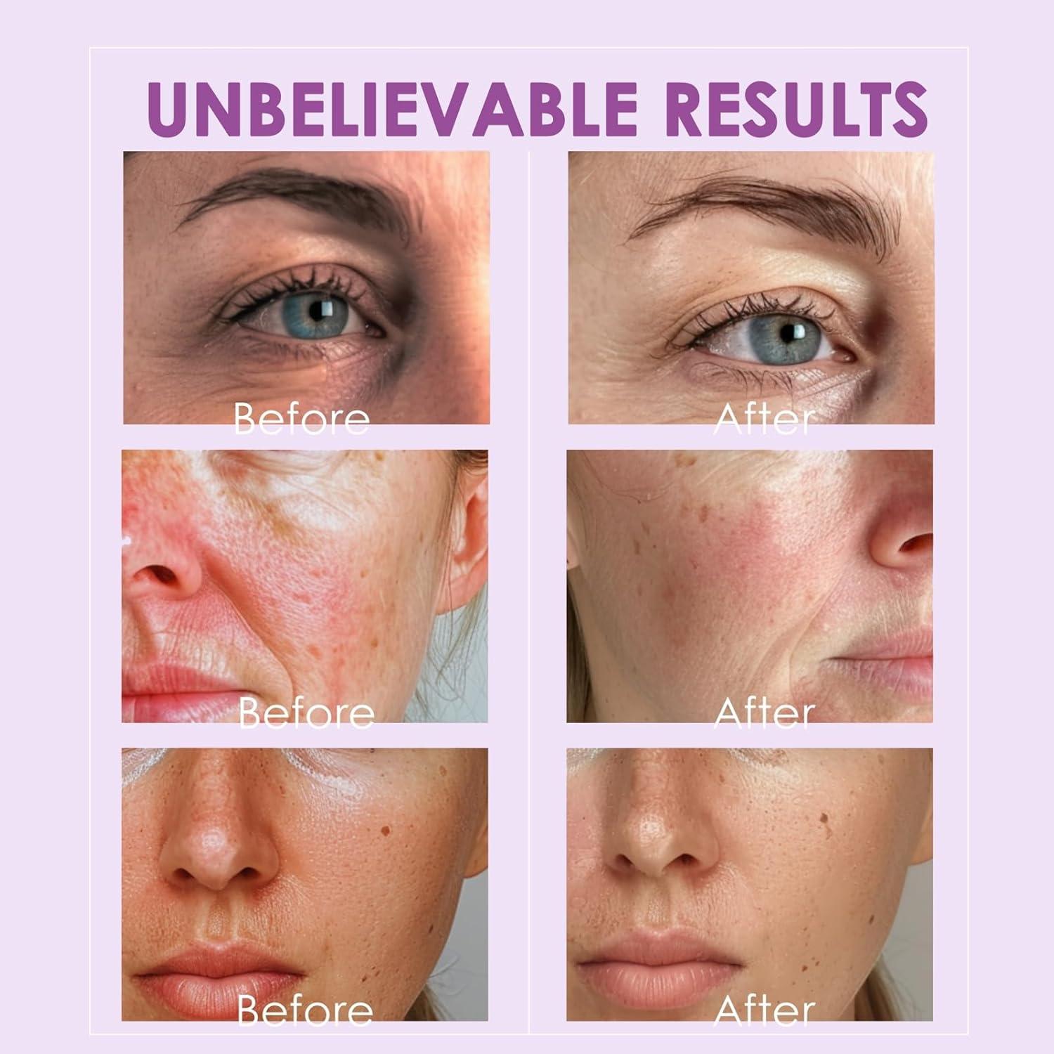 Esferas de Hielo Facial Lazzybeauty - Masajeador Antienvejecimiento