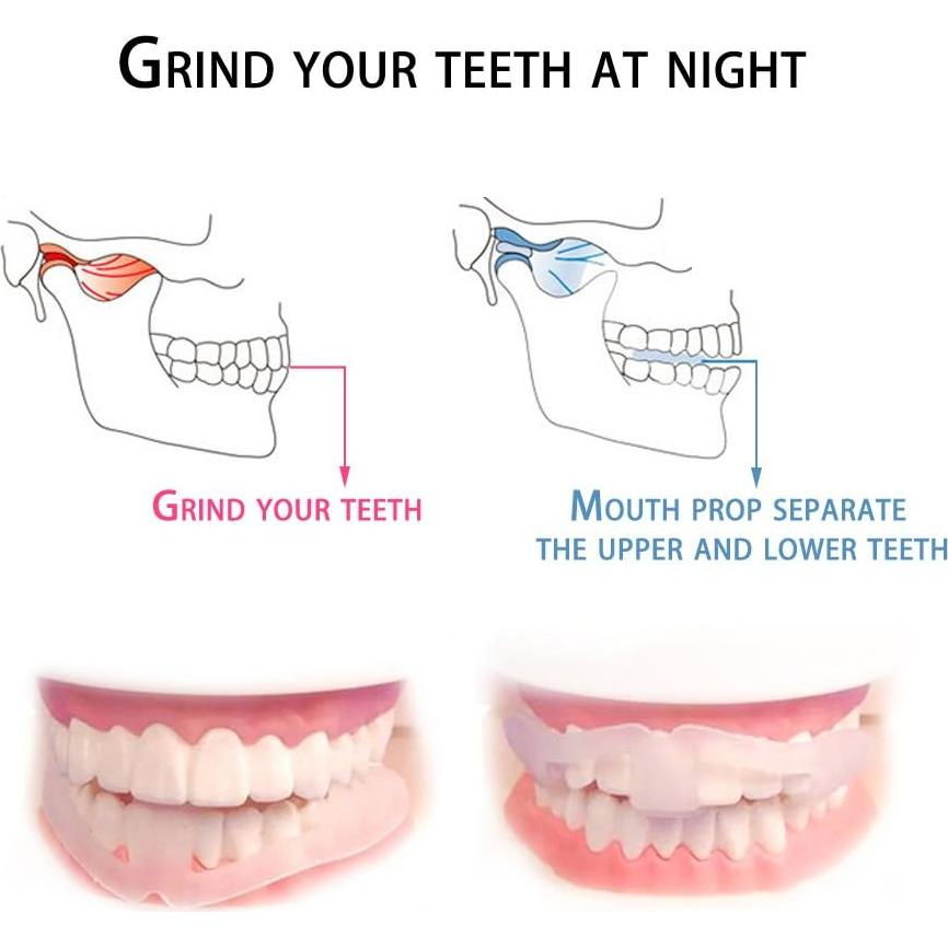 Protector Dental BKID Anti Bruxismo - Guardias de Dientes