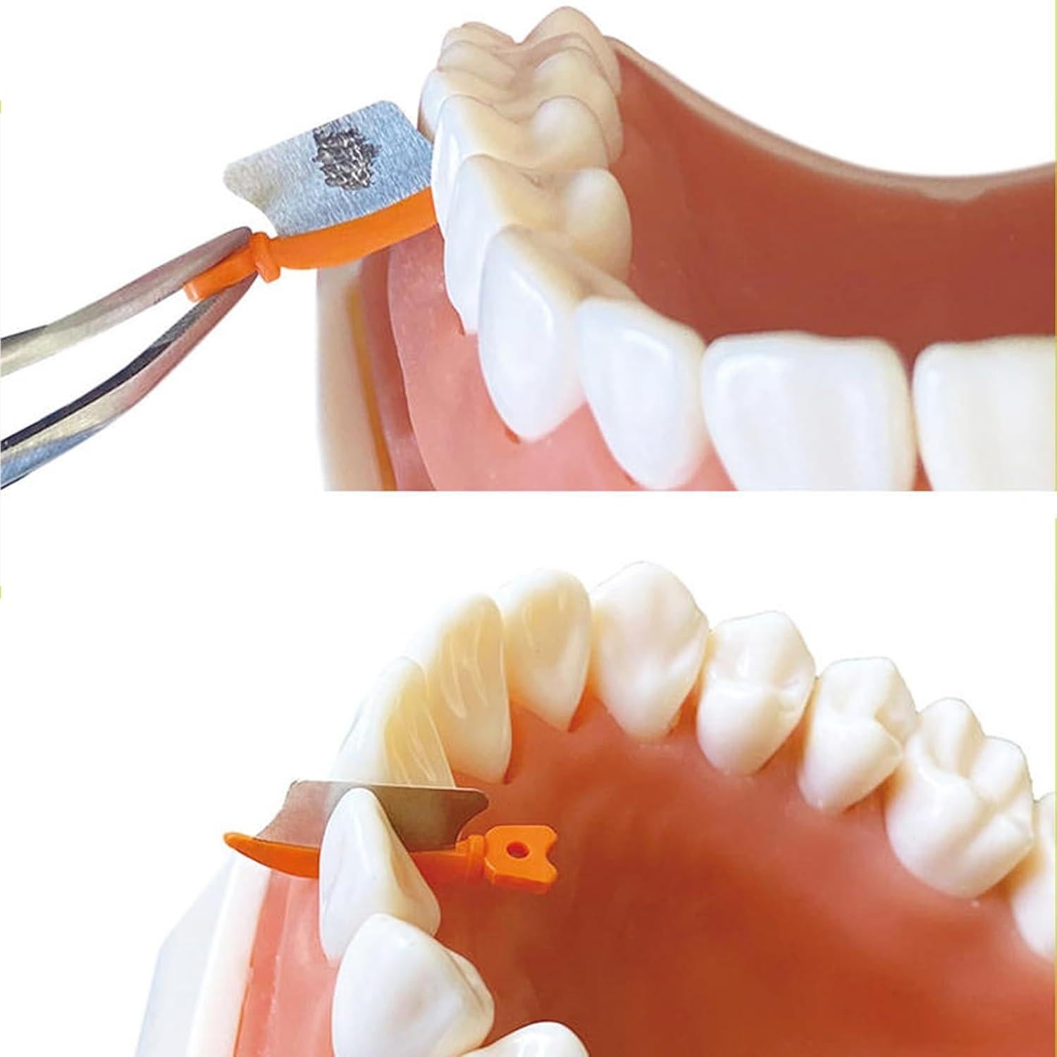 Cuchillos de Cuña Dental Windplusya 72PCS - Protección Interproximal