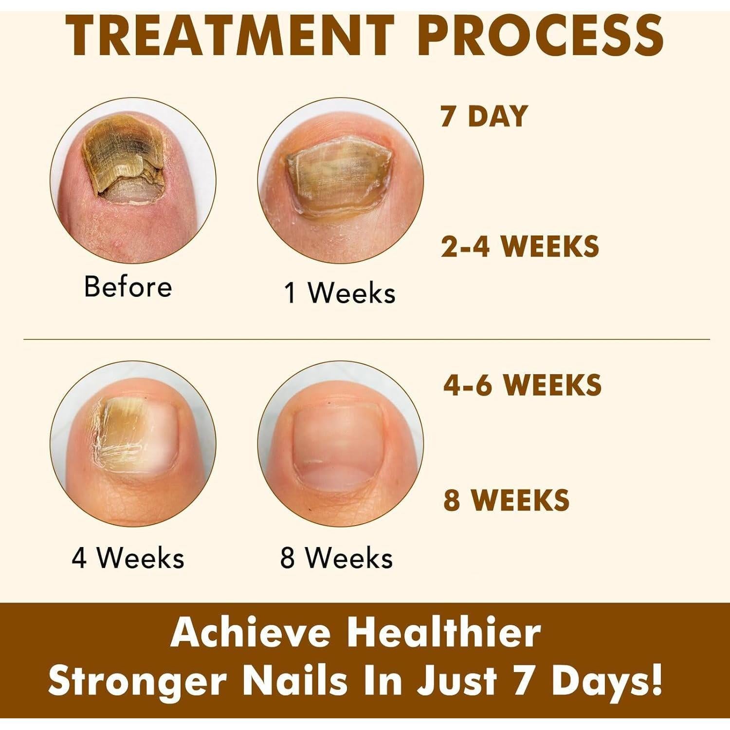Suero de Jengibre para Uñas - Aceite Natural Fortalecedor