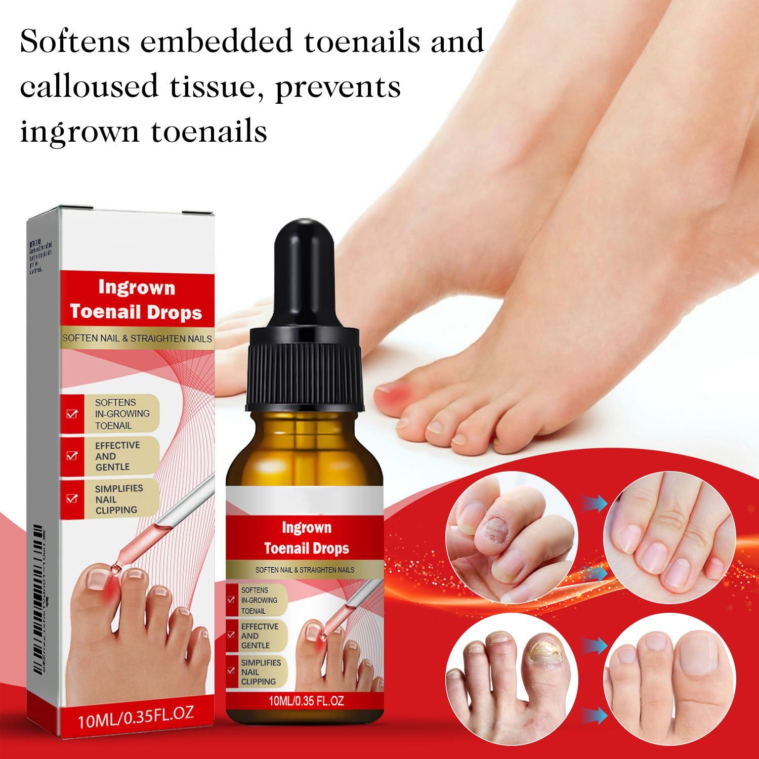 Kit 2 gotas para uñas encarnadas AUJ 10ml - Alivio y suavización