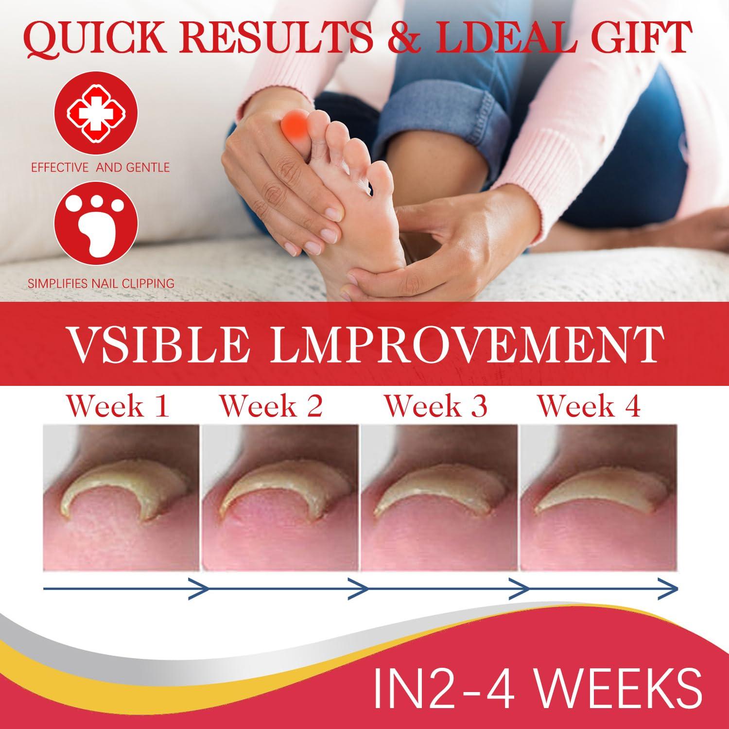 Kit 2 gotas para uñas encarnadas AUJ 10ml - Alivio y suavización