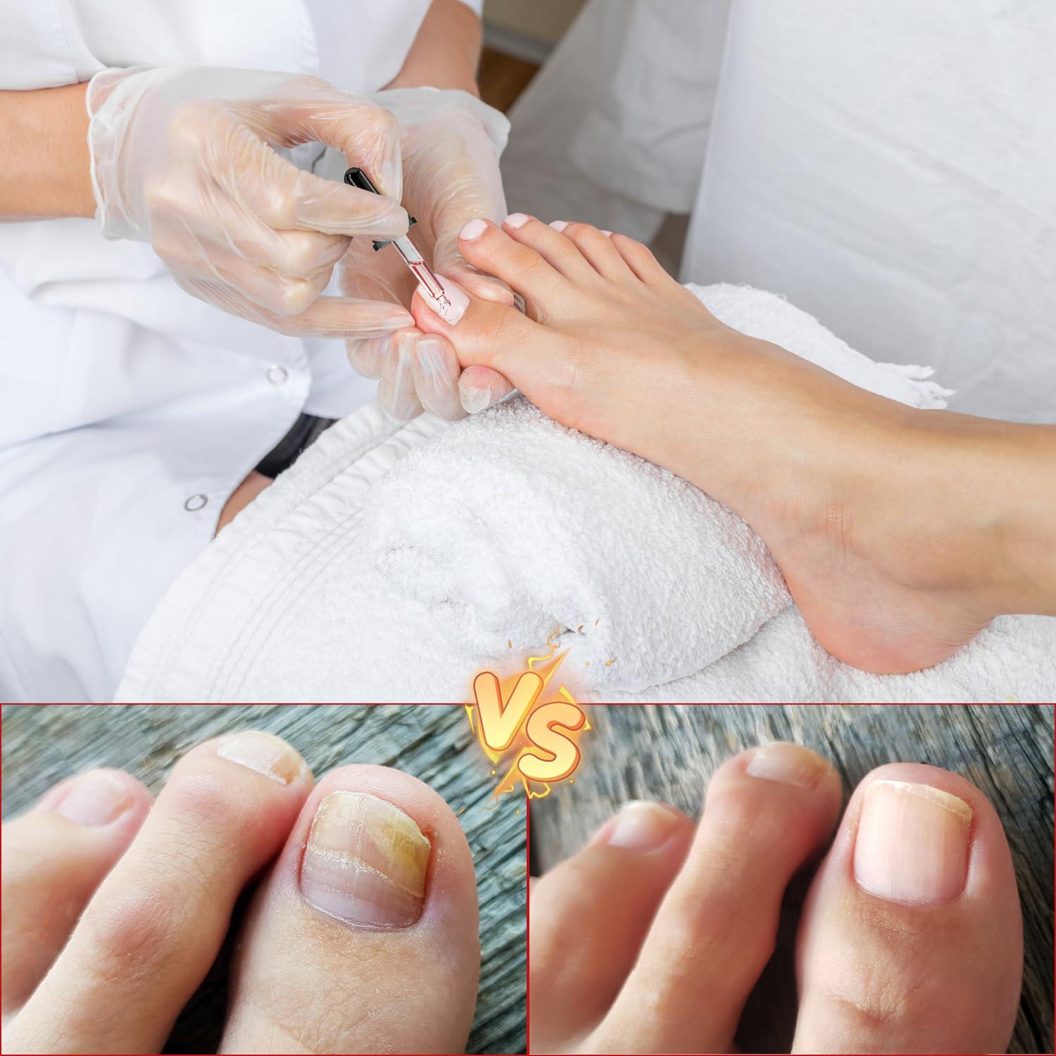 Kit 2 gotas para uñas encarnadas AUJ 10ml - Alivio y suavización