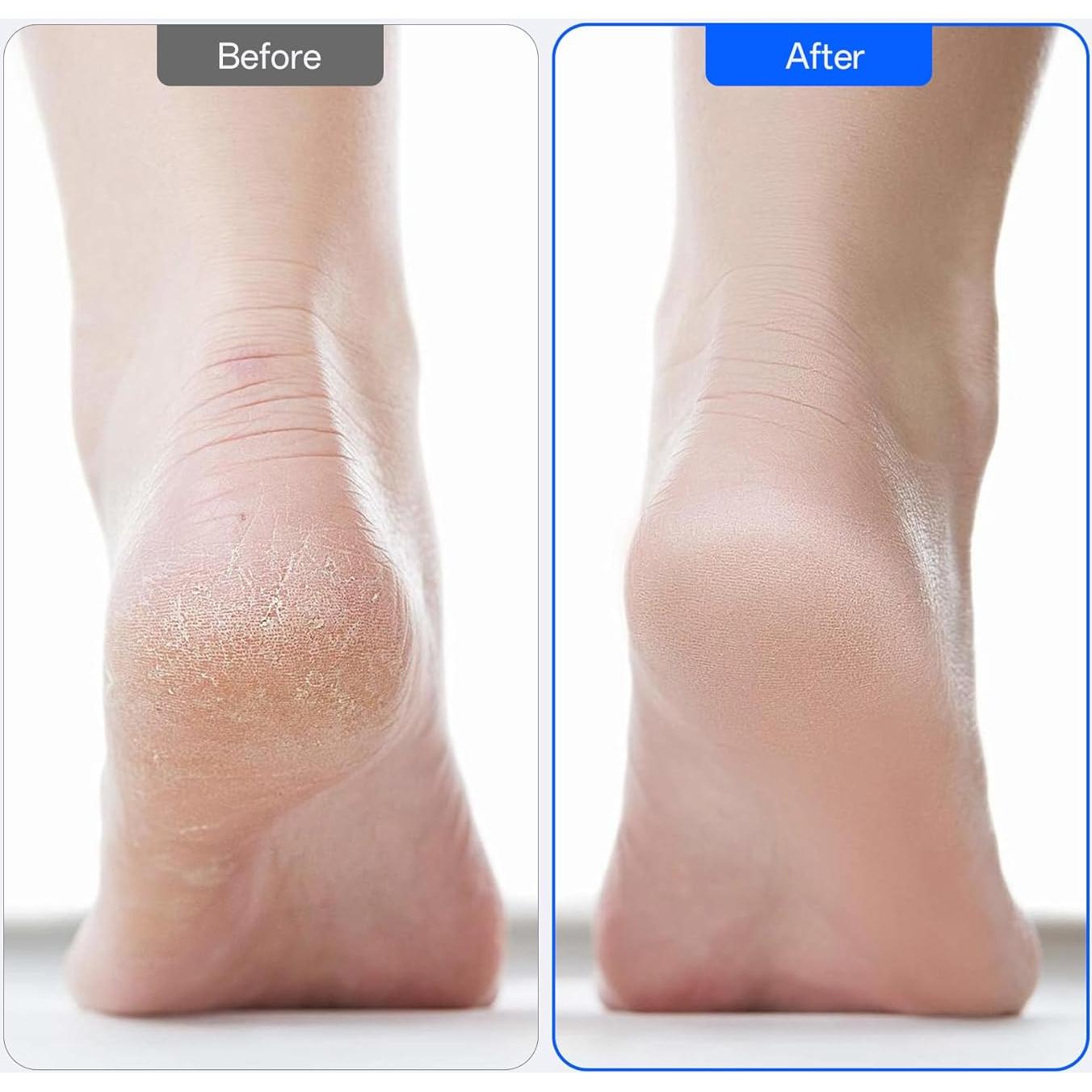 Removedor de Callos Eléctrico Niomuis con 60 Discos - Negro