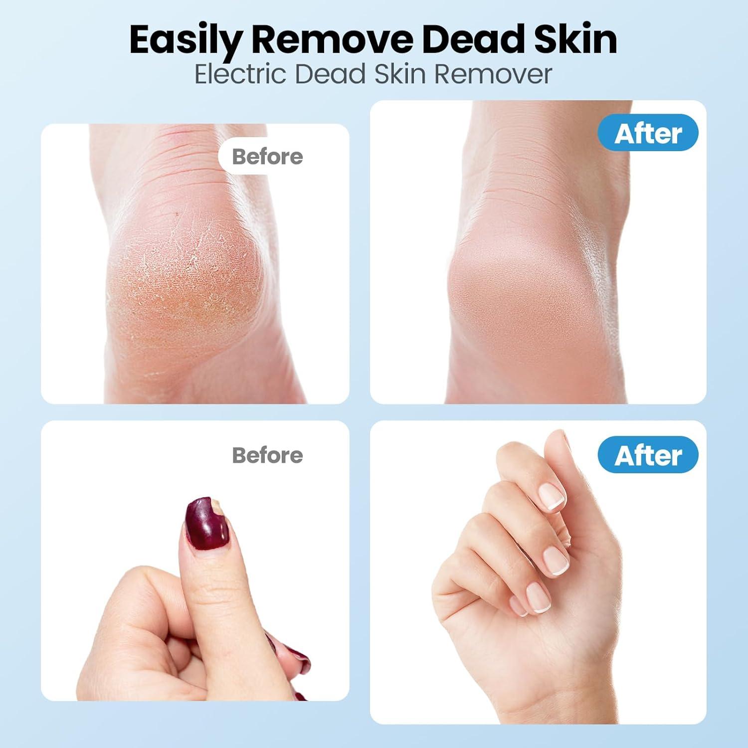 Removedor de Callos Eléctrico Mosthink 2 en 1 Inalámbrico Negro