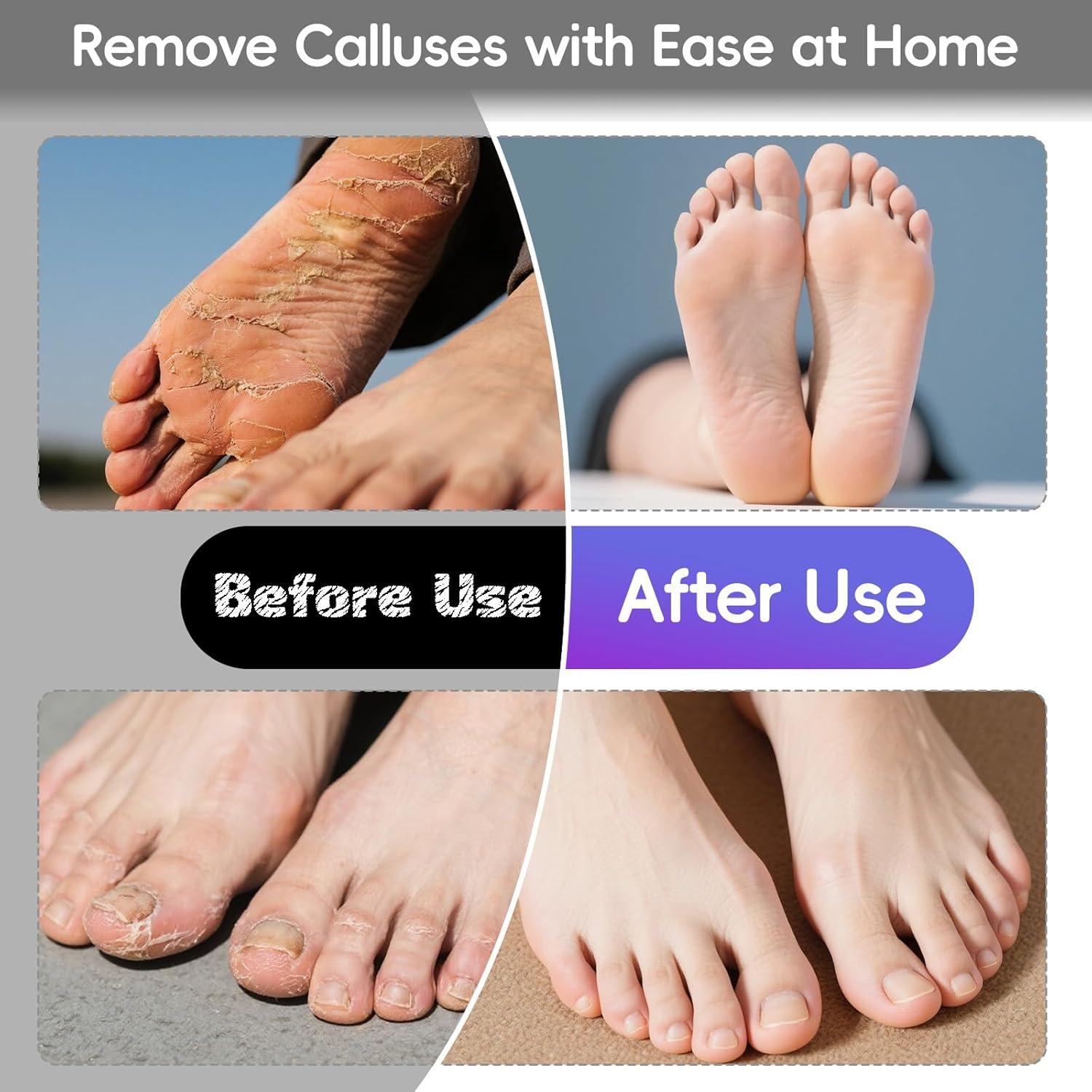 Removedor de Callos Eléctrico StepLively 11.94 cm con 60 Discos