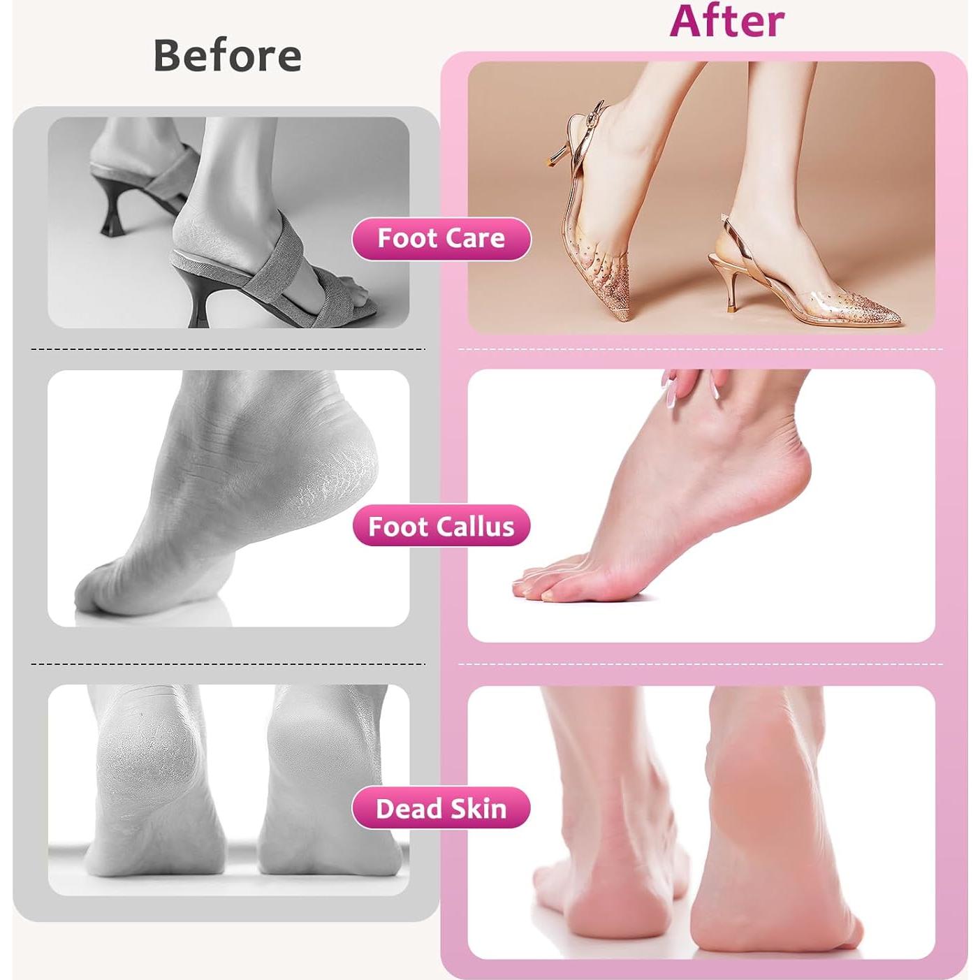 Removedor de Callos Eléctrico Ekaipo Rosa con 60 Discos