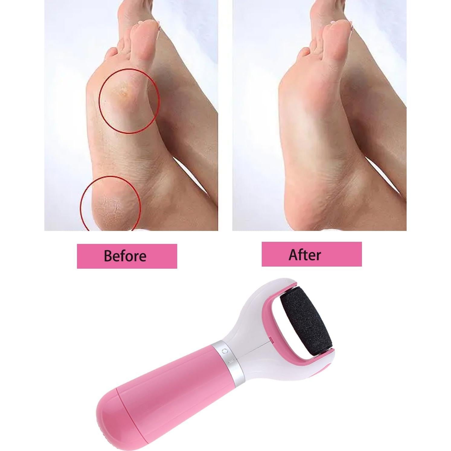 Removedor de Callos Eléctrico WenTigDY Rosa con Rodillo