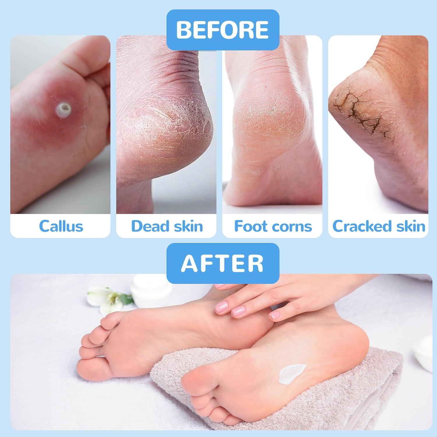 Removedor de Callos Eléctrico Recargable ShenZhen A1 - 3 Velocidades