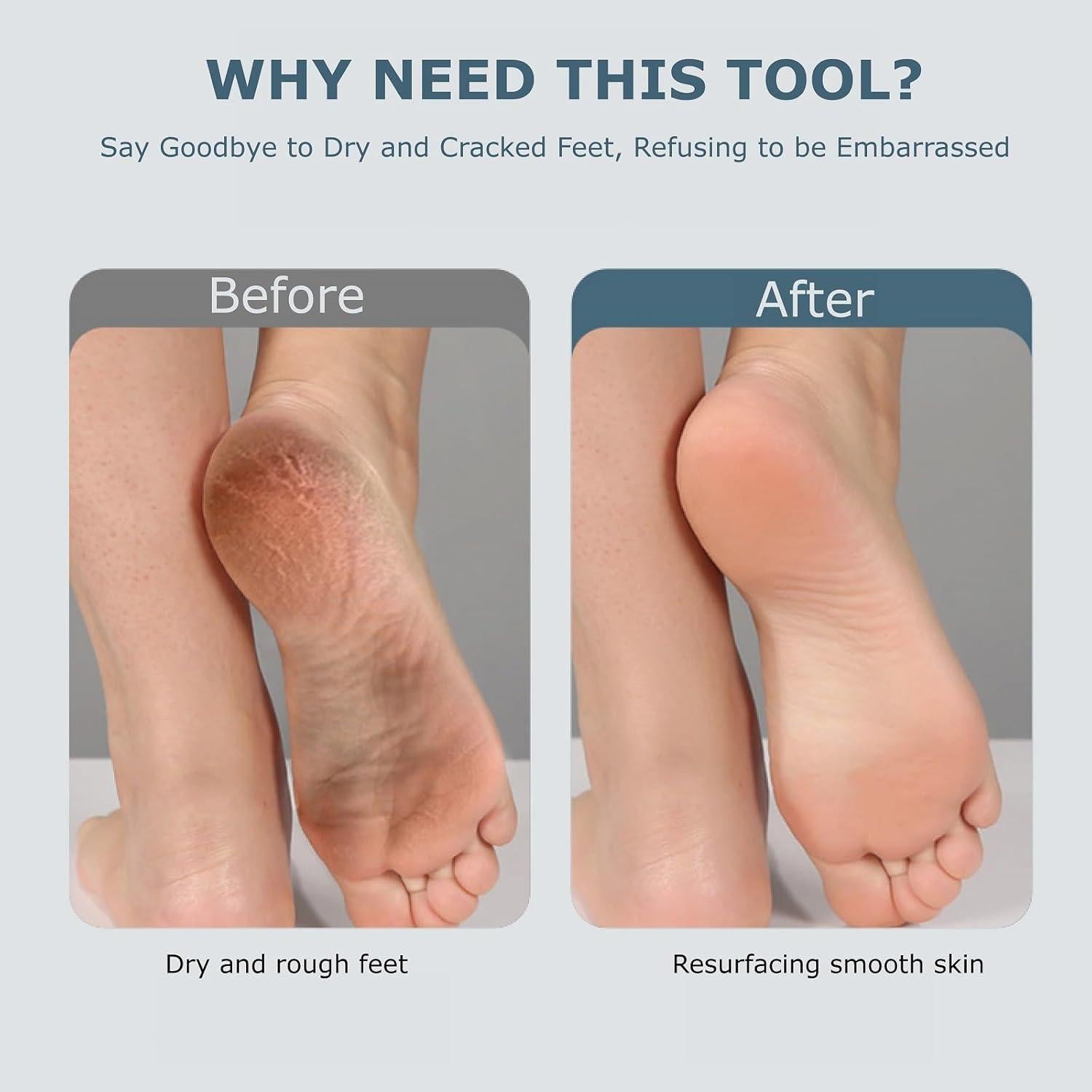 Removedor de Callos Eléctrico Fooseey con 3 Cabezas y Carga USB