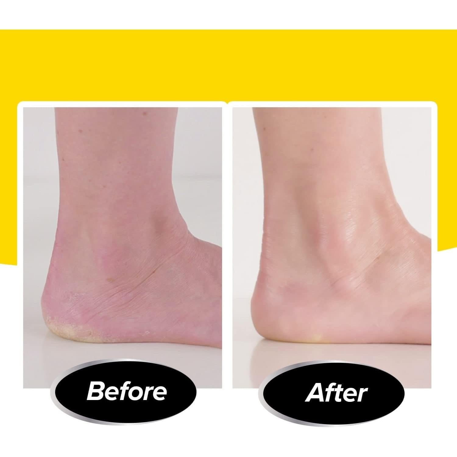 Removedor de Callos Eléctrico PediVac con Aspiradora y Luz LED