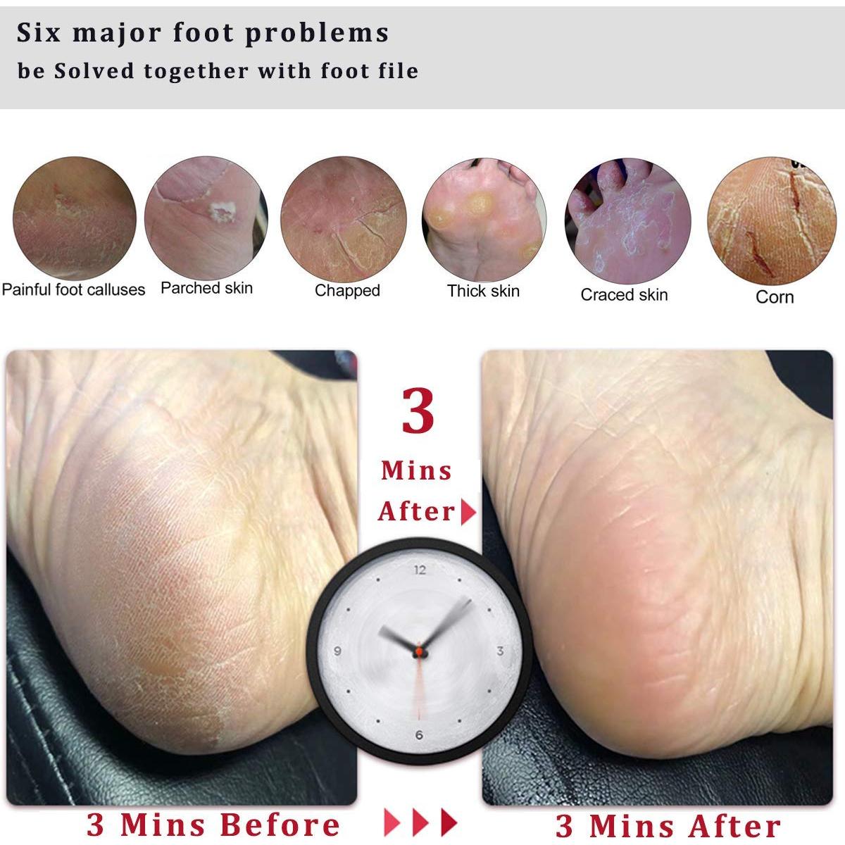 Lima para Pies Kinepi - Removedor de Callos Profesional 25cm