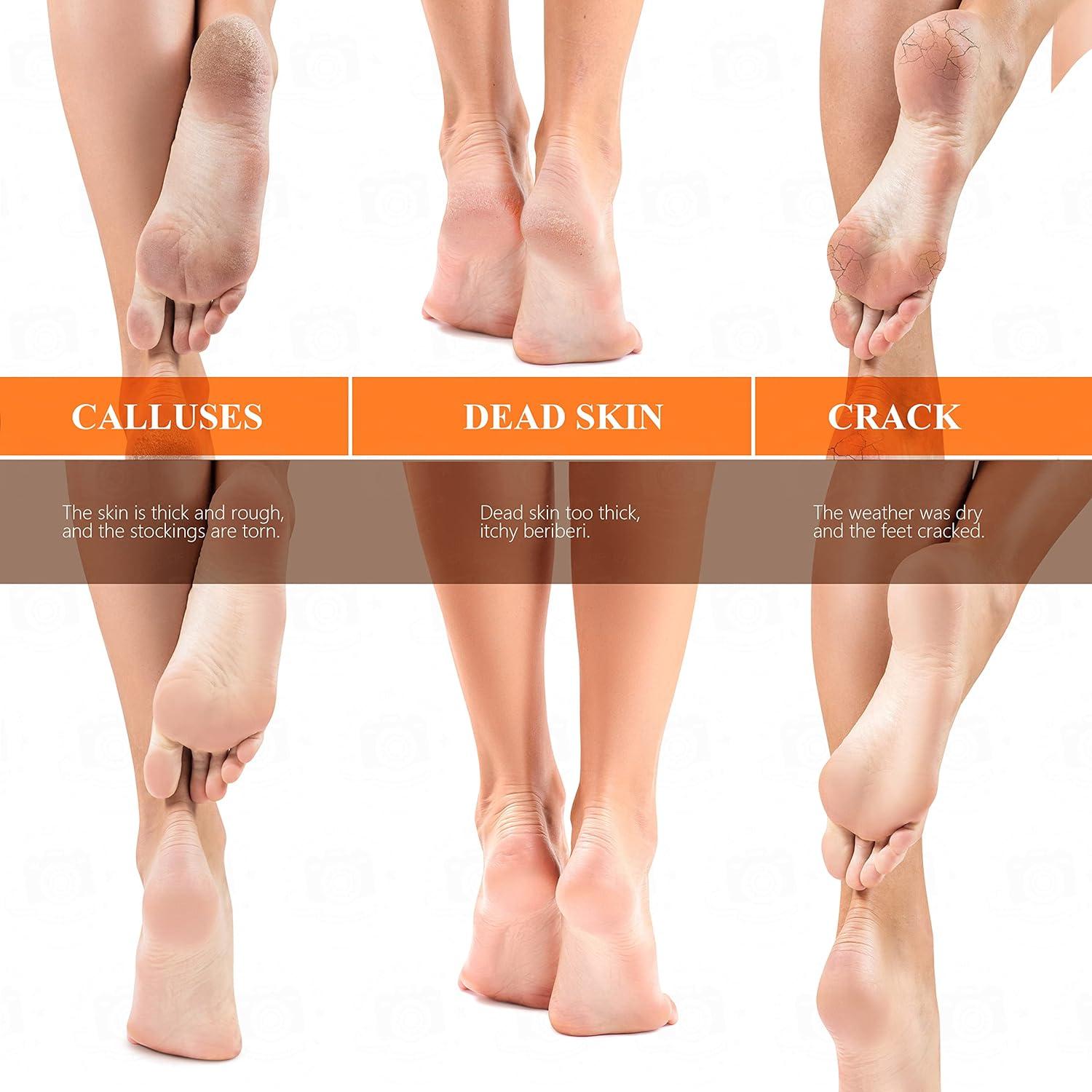 Removedor de Callos Fotwen Nano Foot Scrubber 2025 - Lima para Pies