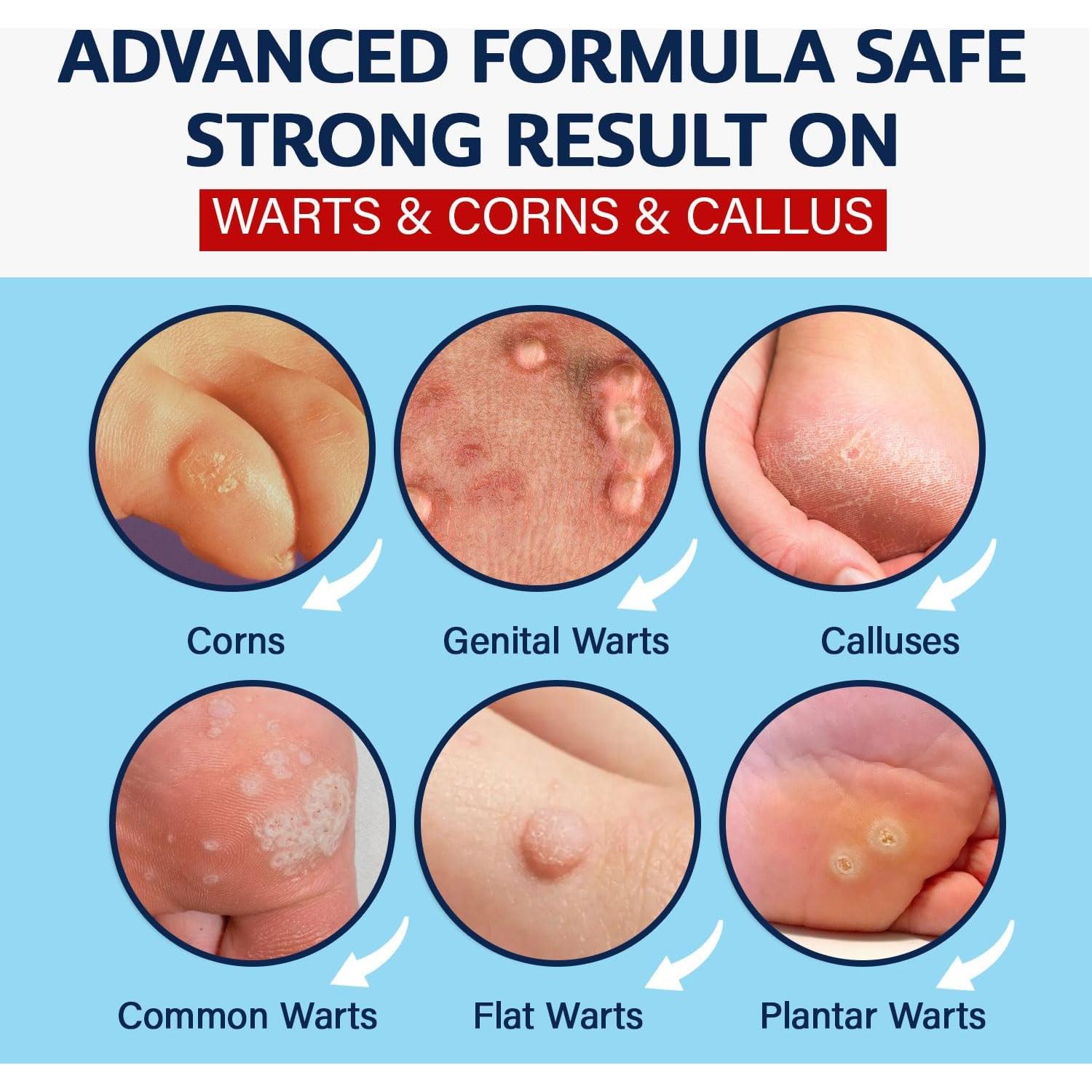 Removedor de Verrugas MEOLY 30 ML - Acción Rápida Ácido Salicílico