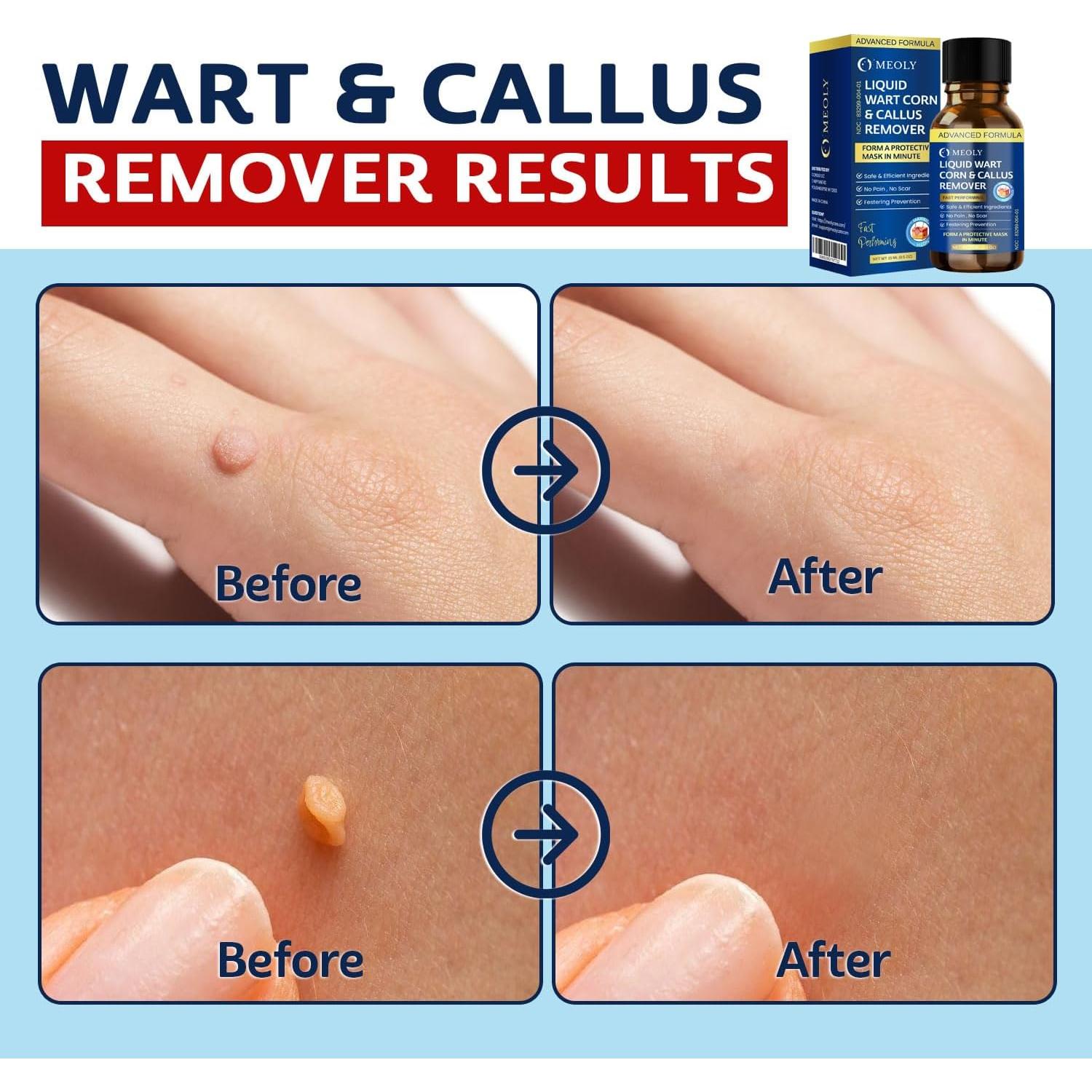 Removedor de Verrugas MEOLY 30 ML - Acción Rápida Ácido Salicílico