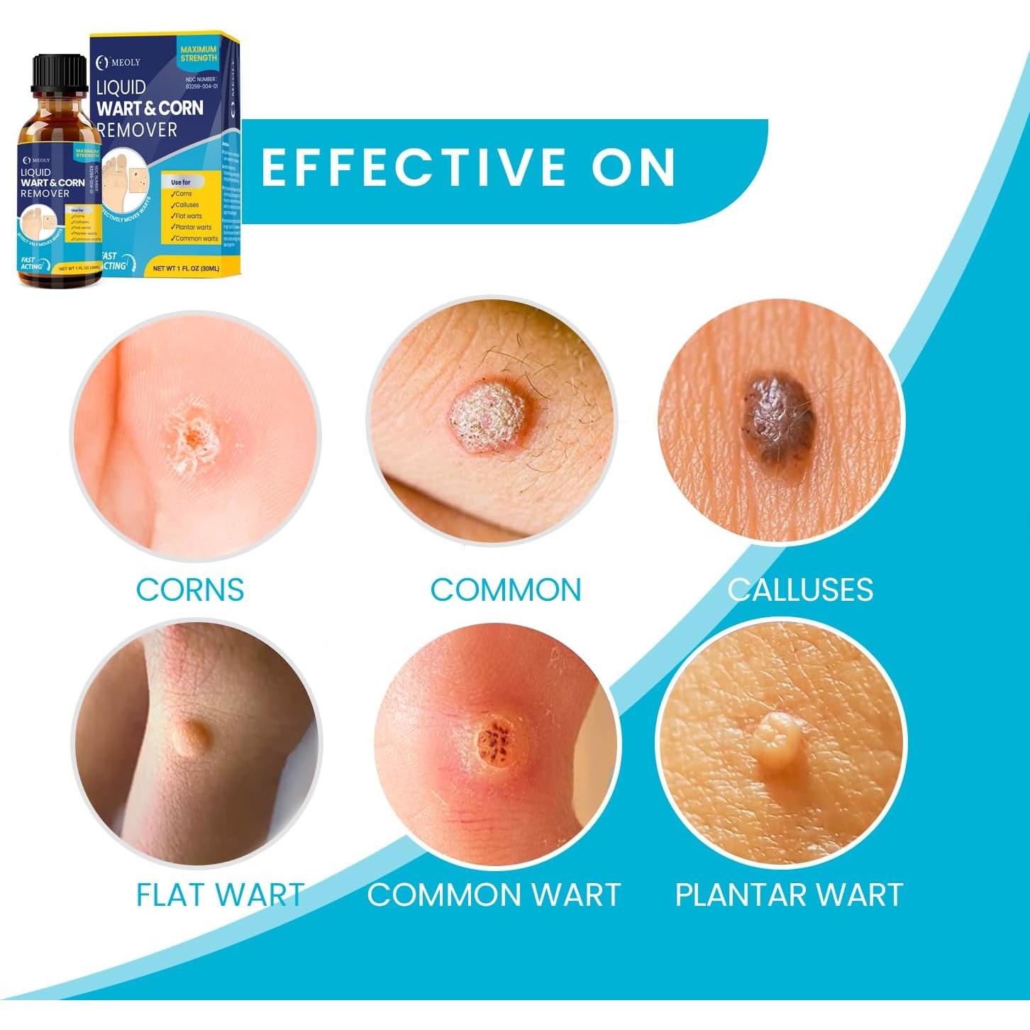 Eliminador de Verrugas Ácido Salicílico MOELY 30 ML Rápido