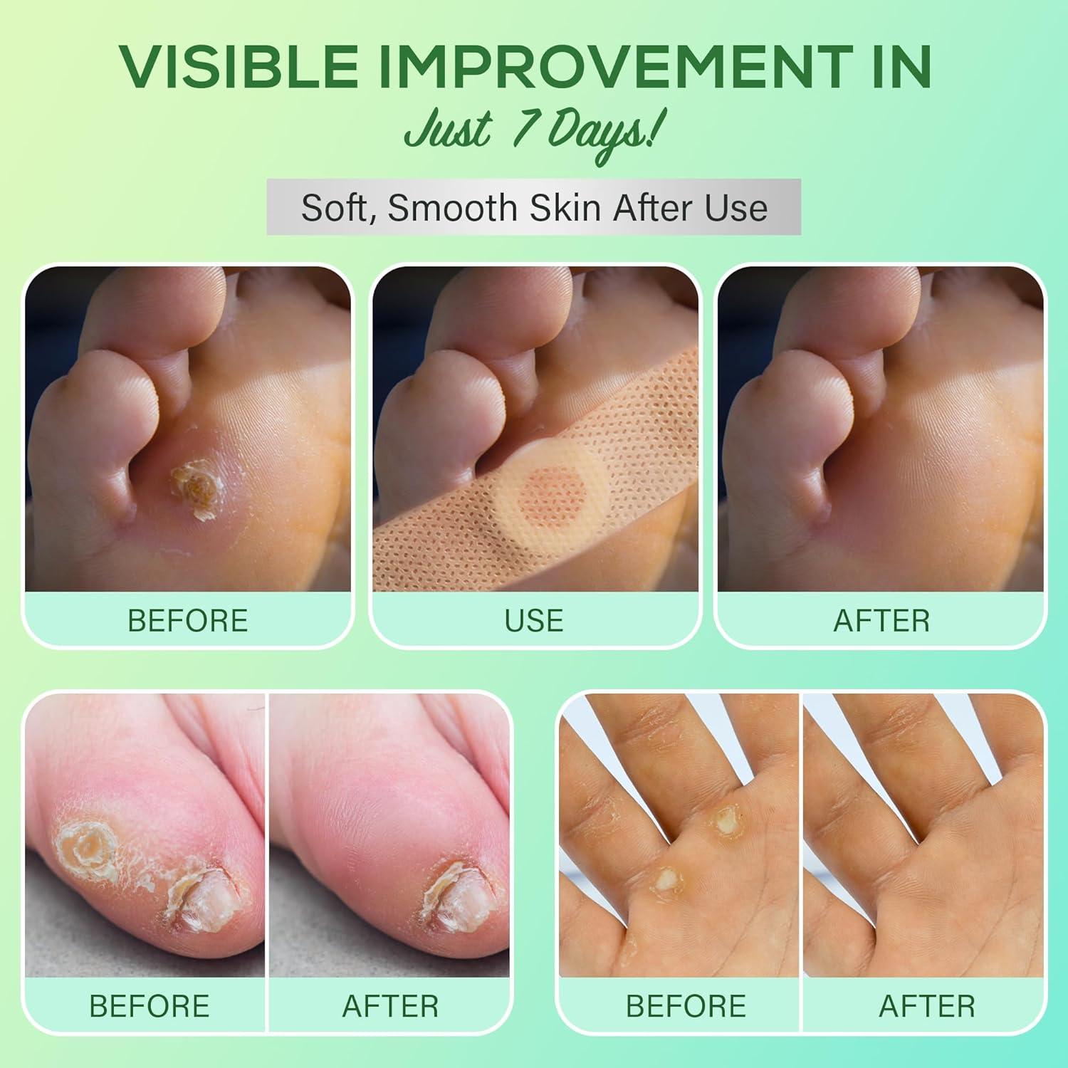 Almohadillas para Callos SupreH - 23 Unidades con 40% Ácido Salicílico