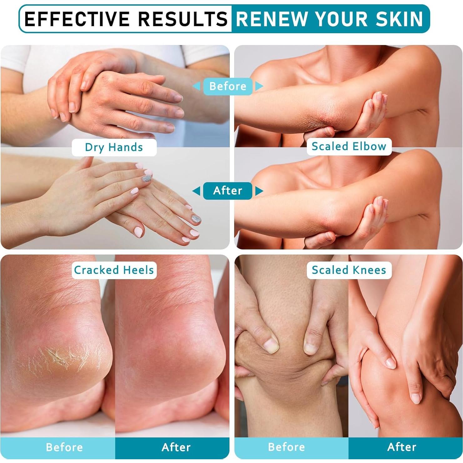 Crema de Urea 40% Aphesia para Pies Secos 150g - Hidratante