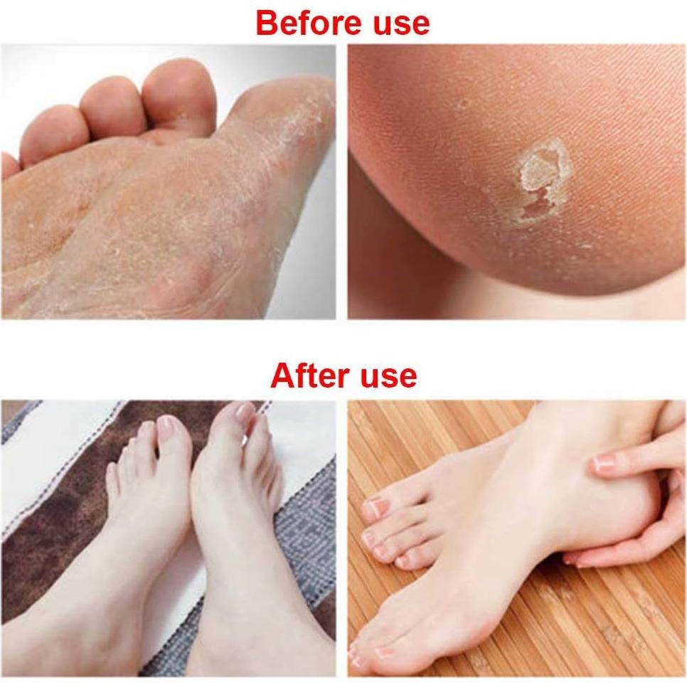 6 Piezas Lima de Pies Paddsun Removedor de Callos Acero Inoxidable