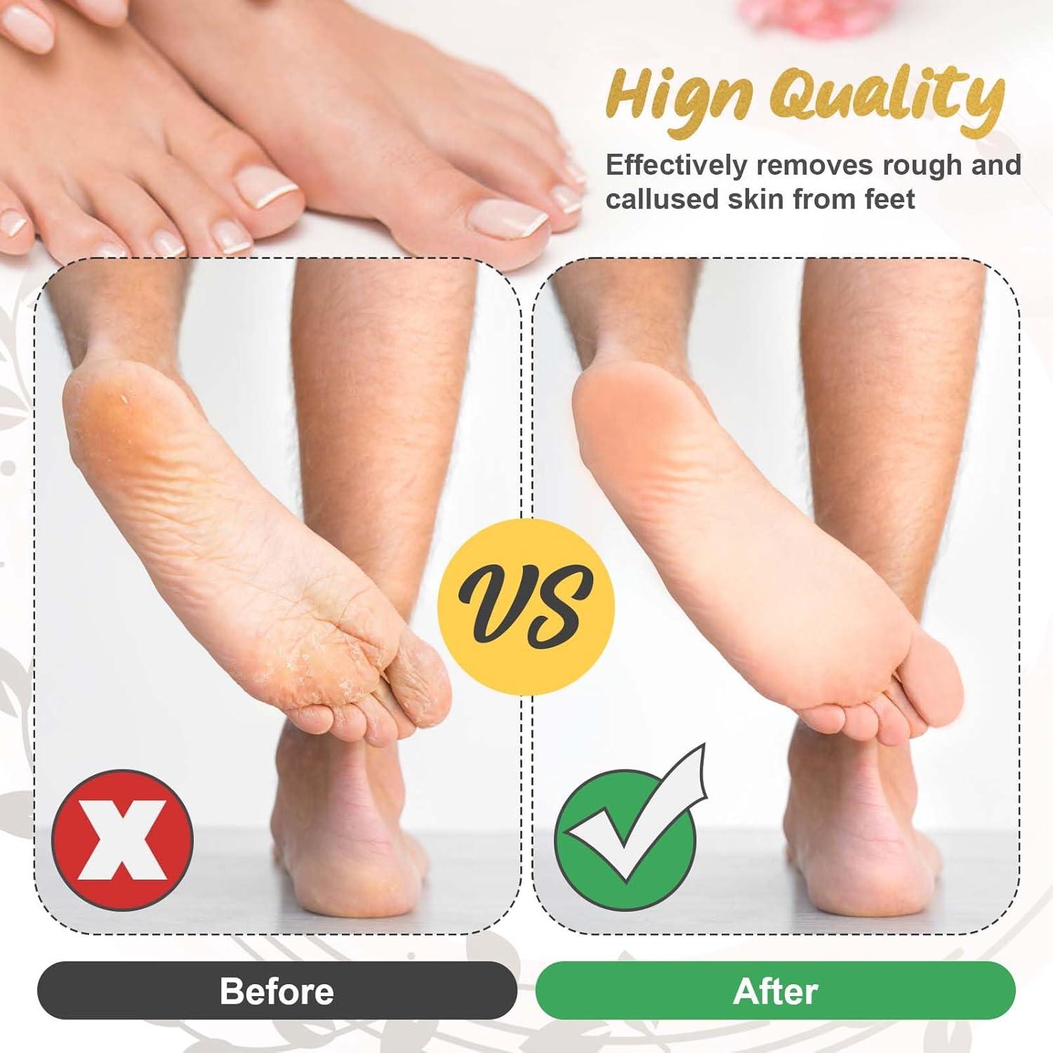 Paquete de 9 cabezales de repuesto para removedor de callos Sankoly