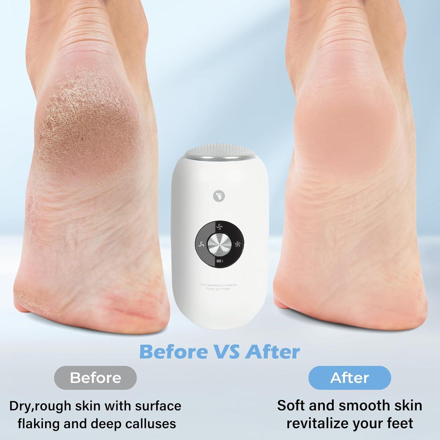 Removedor de Callos Eléctrico NUAOI A1 - 3 Velocidades, 2 Cabezas