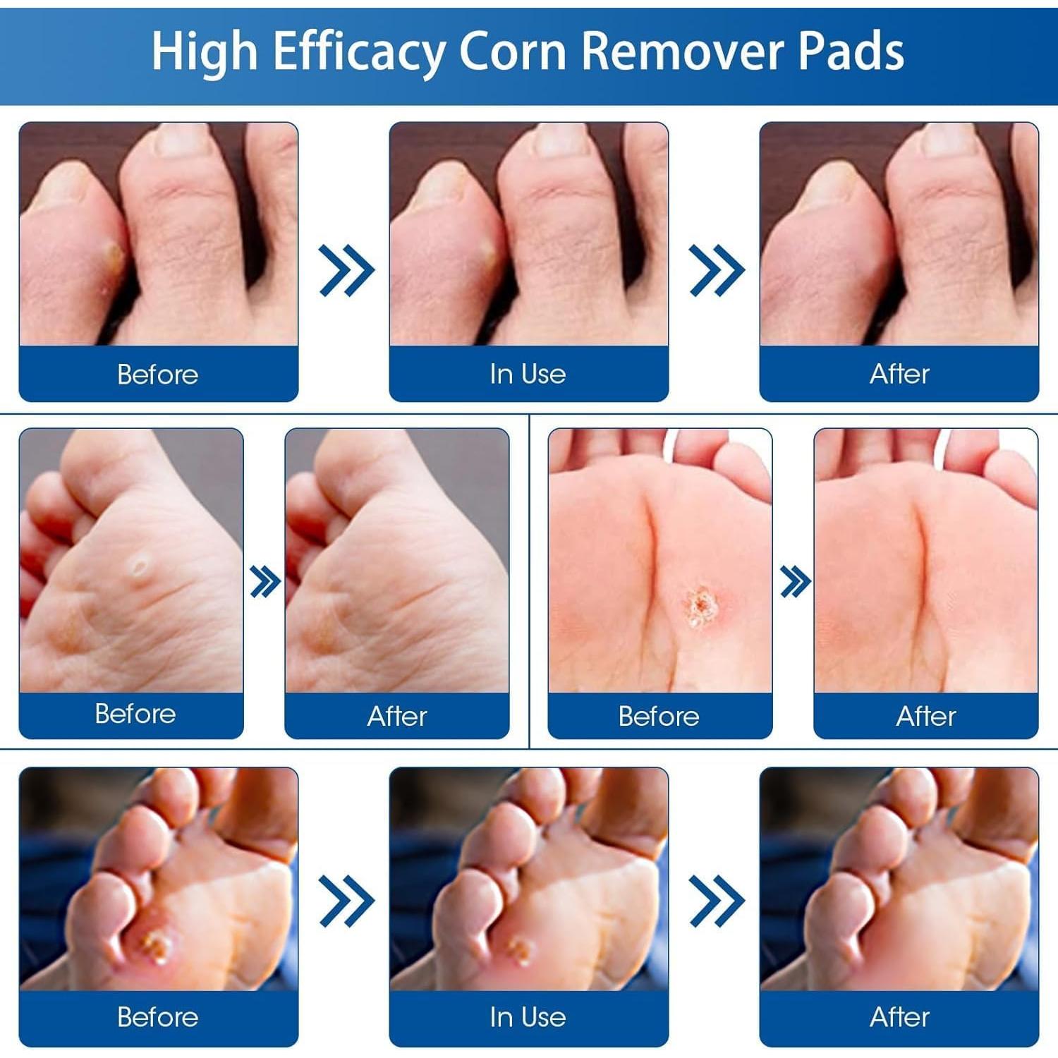 48 Almohadillas Removedoras de Callos MQUPIN - Efectivas y Naturales