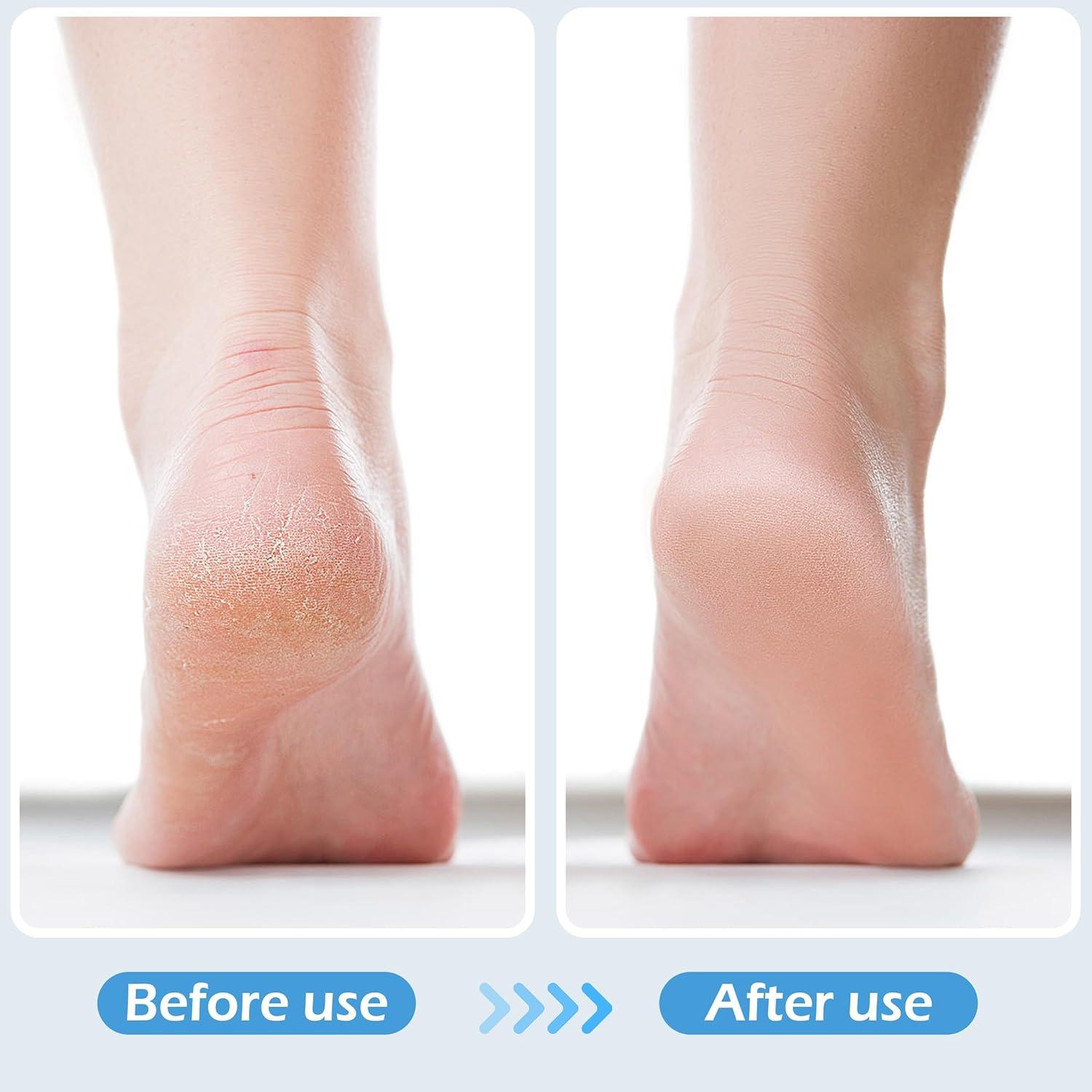 Kit 4 en 1 Cepillo para Pies Exfoliante con Piedra Pómez