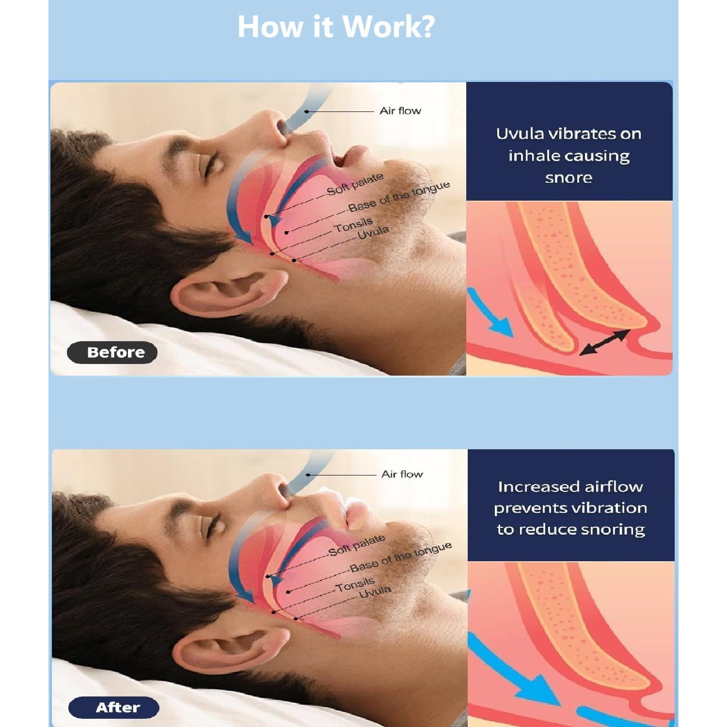 Dispositivos Anti Ronquidos WELEQUT - Paquete de 8 Clips Nasales