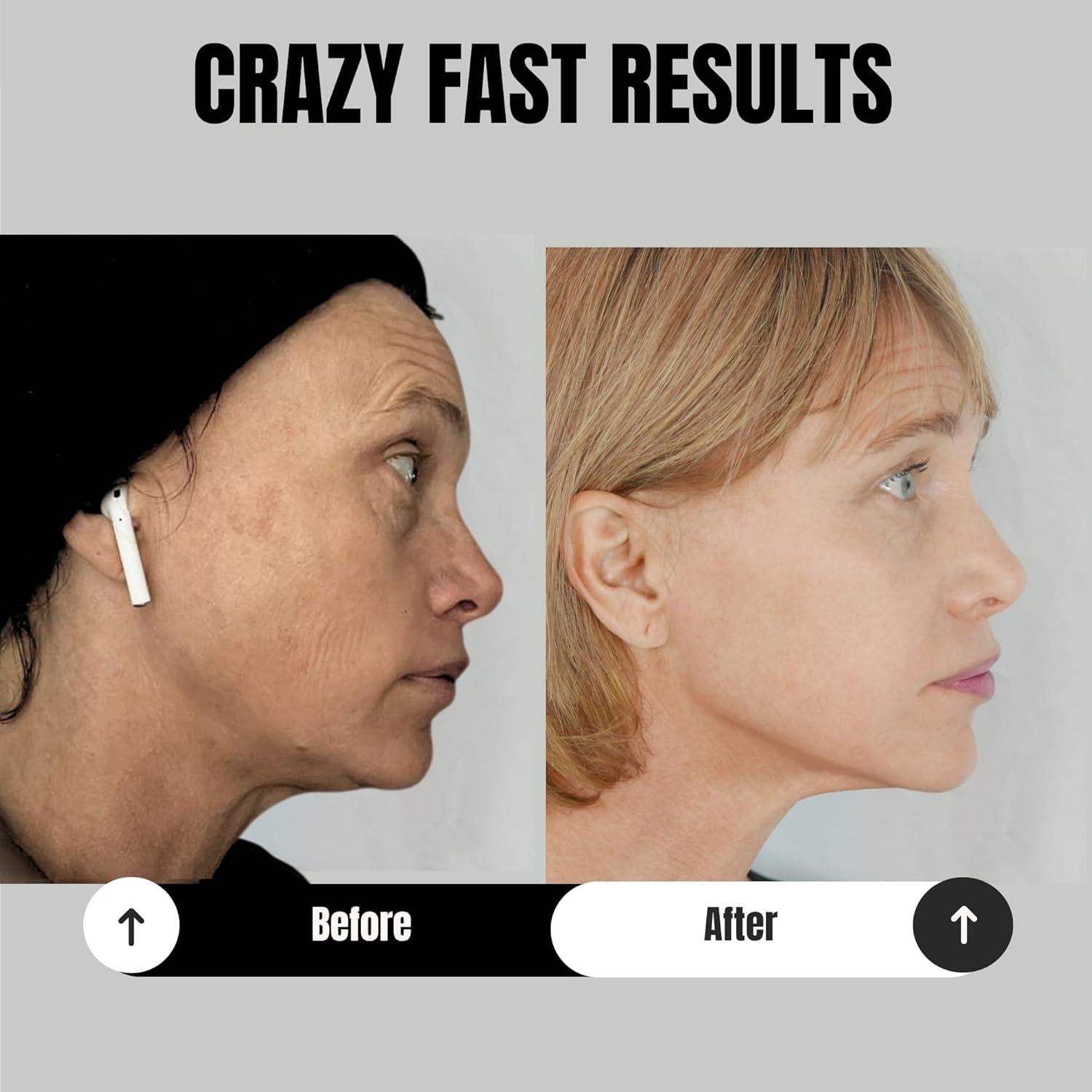 Entrenador de Mandíbula JAW-X Pro - Ejercitador Facial Completo