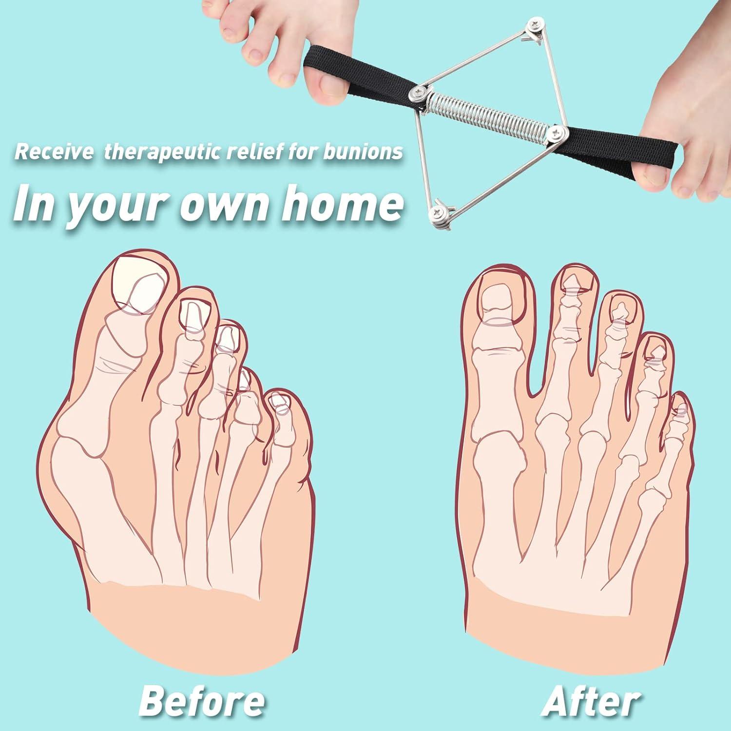 Separador de Dedos Tondiamo para Juanetes - Alivio y Ejercicio