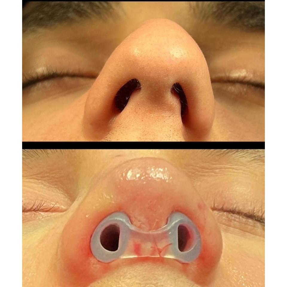 Retenedor de Nostril Footline BR-11 para Recuperación de Rinoplastia