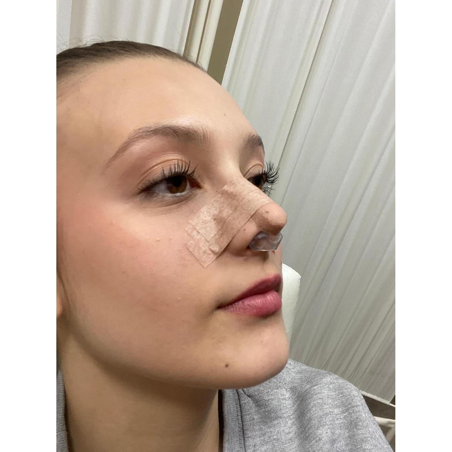 Retenedor de Nostril Nanovita para Rinoplastia - Silicona Médica