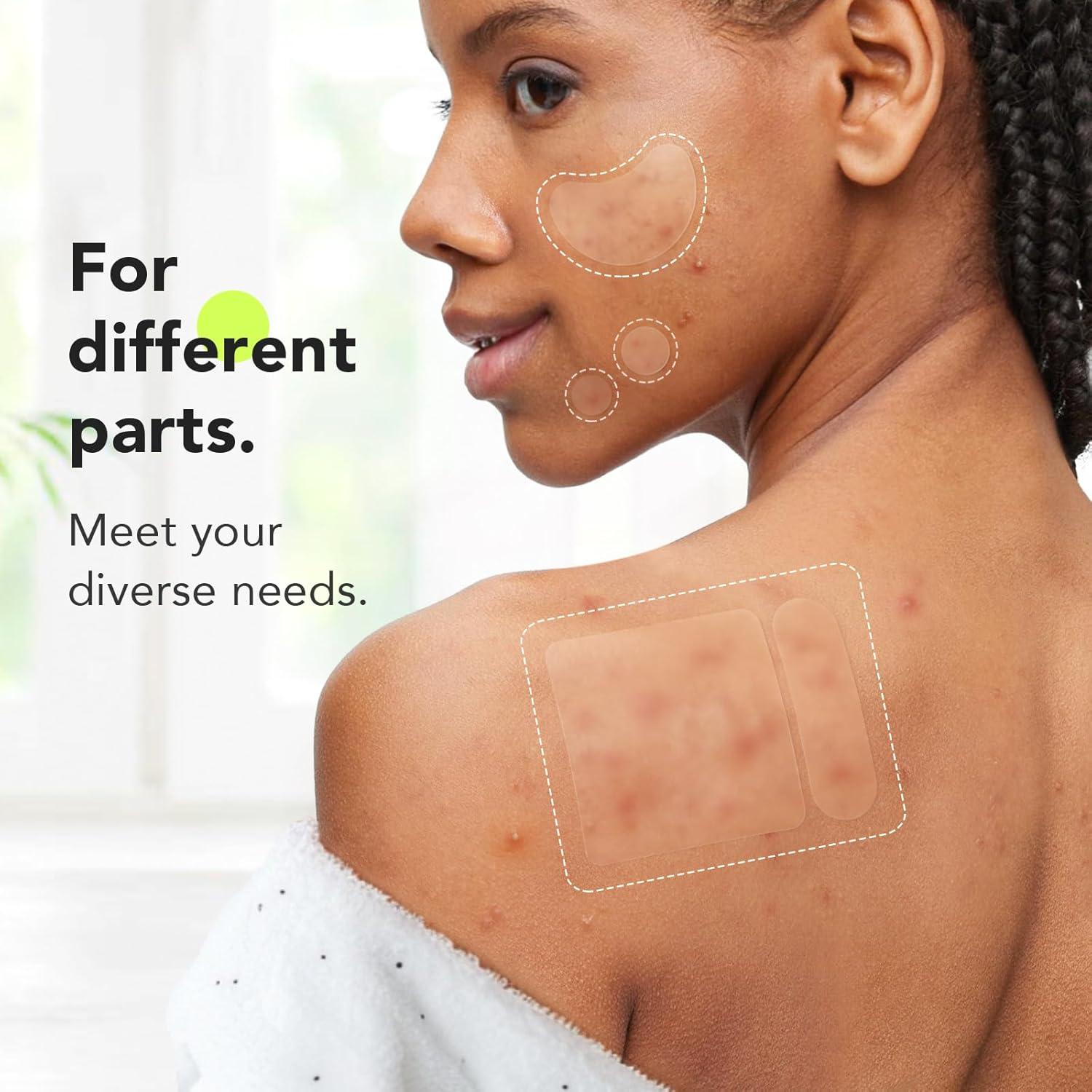 Parches Hidrocoloides para Acné LitBear XL - 112 Cuentas