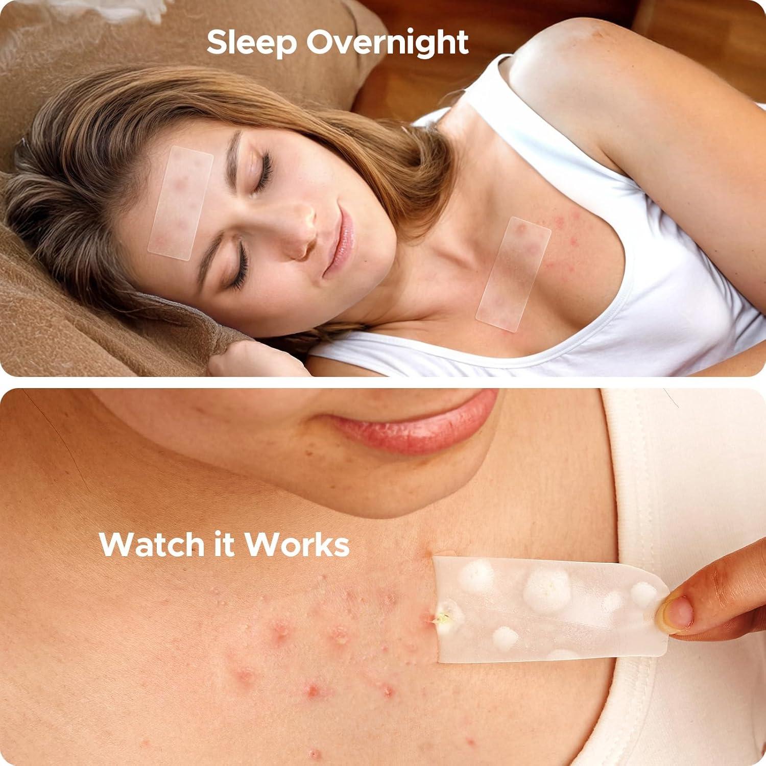 Parches para Acné TKTK XL 68x27mm - 24 Piezas Hidrocoloides