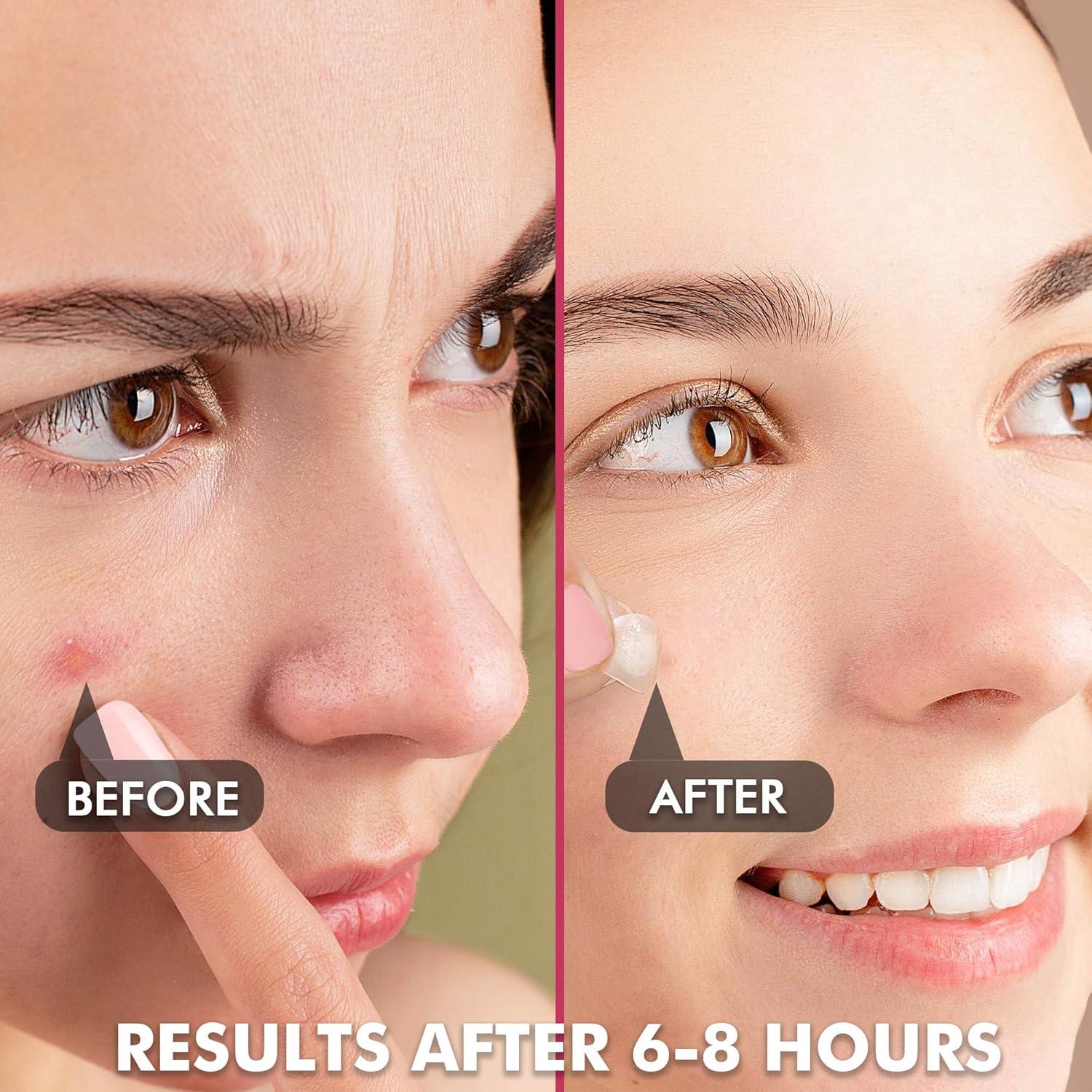 Parche Invisible para Granitos Albatross Health 180 Unidades