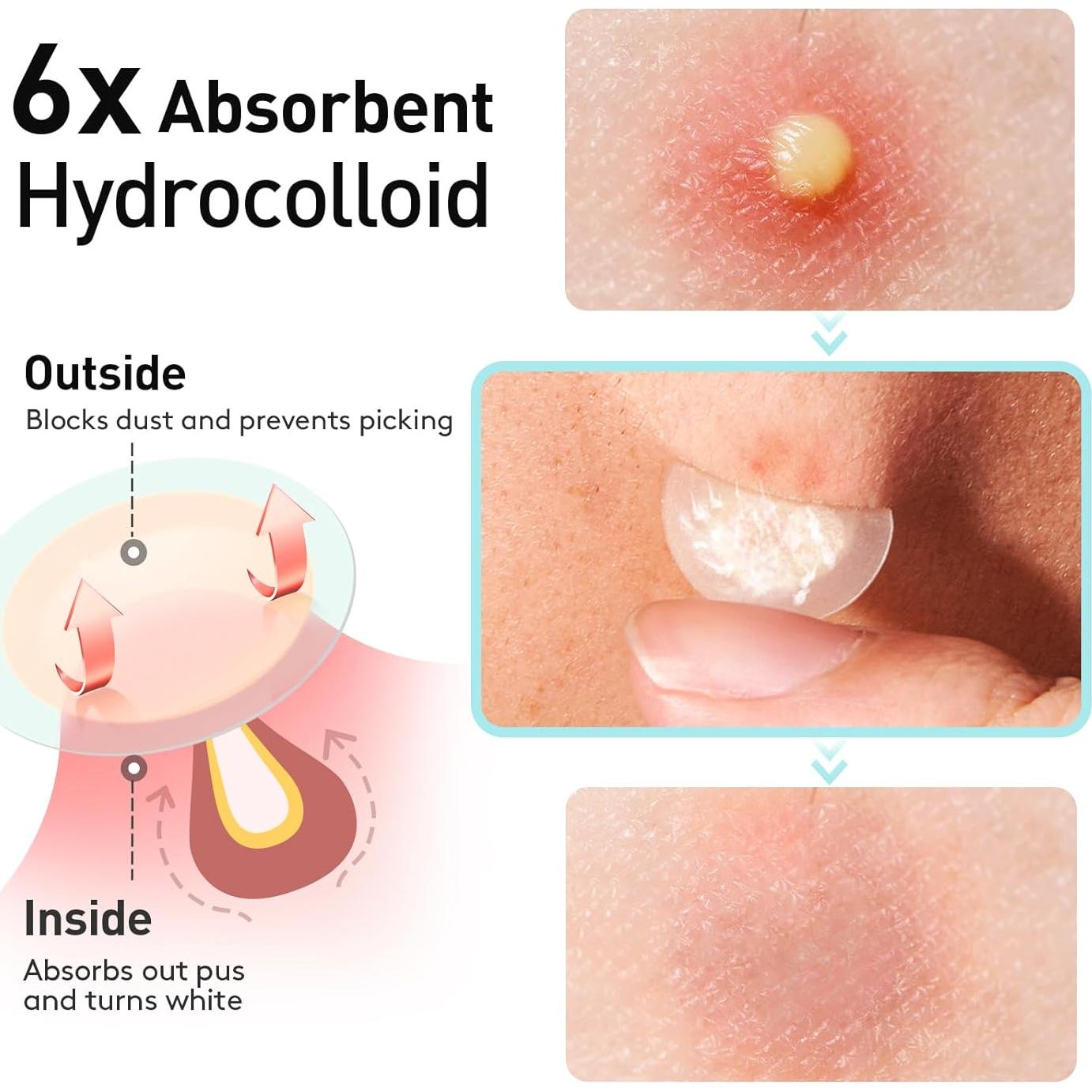 Parche para Acné TKTK 12mm Hidrocoloide 48 Unidades