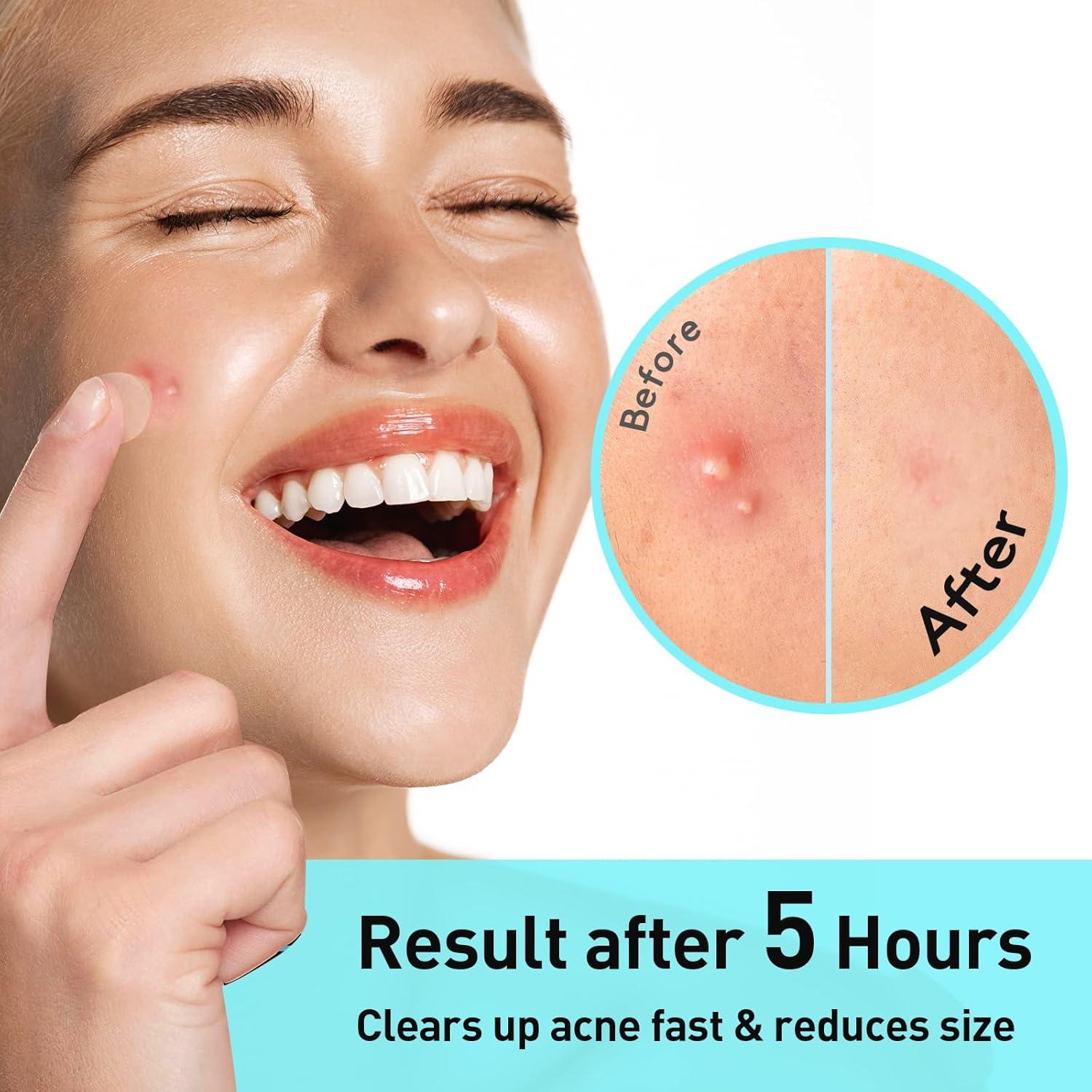 Parche para Acné TKTK 12mm Hidrocoloide 48 Unidades