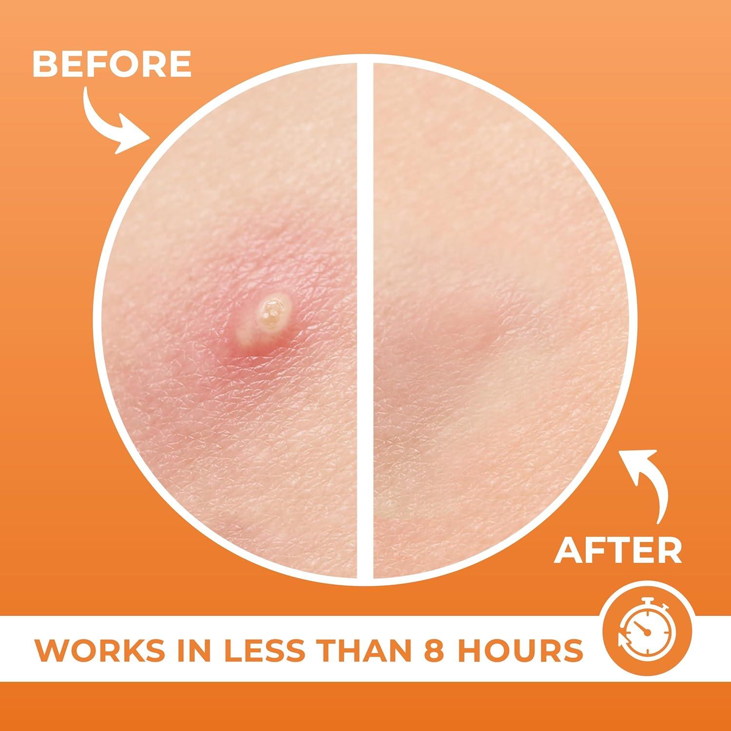 Parche para Granos Hidrocoloide PatchRx - 240 Unidades