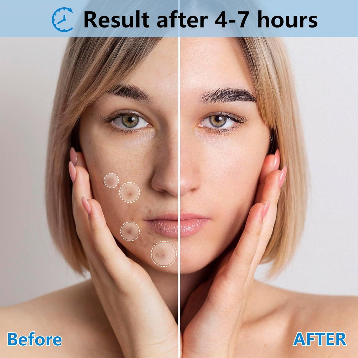 Parches para Acné Hidrocoloides Jo Dominic - 360 Piezas