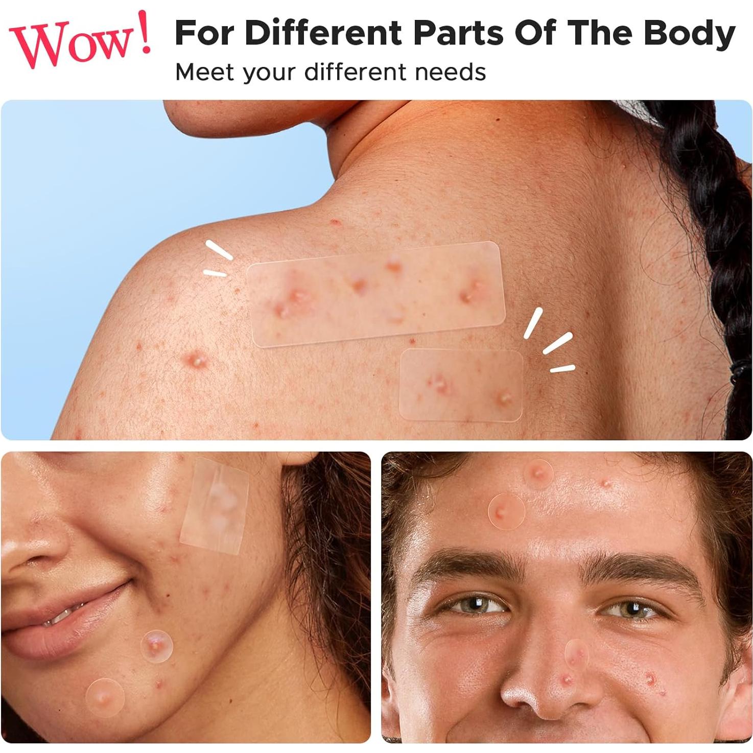 Parche Hidrocoloide para Granos LitBear - 156 Parches, 5 Tamaños