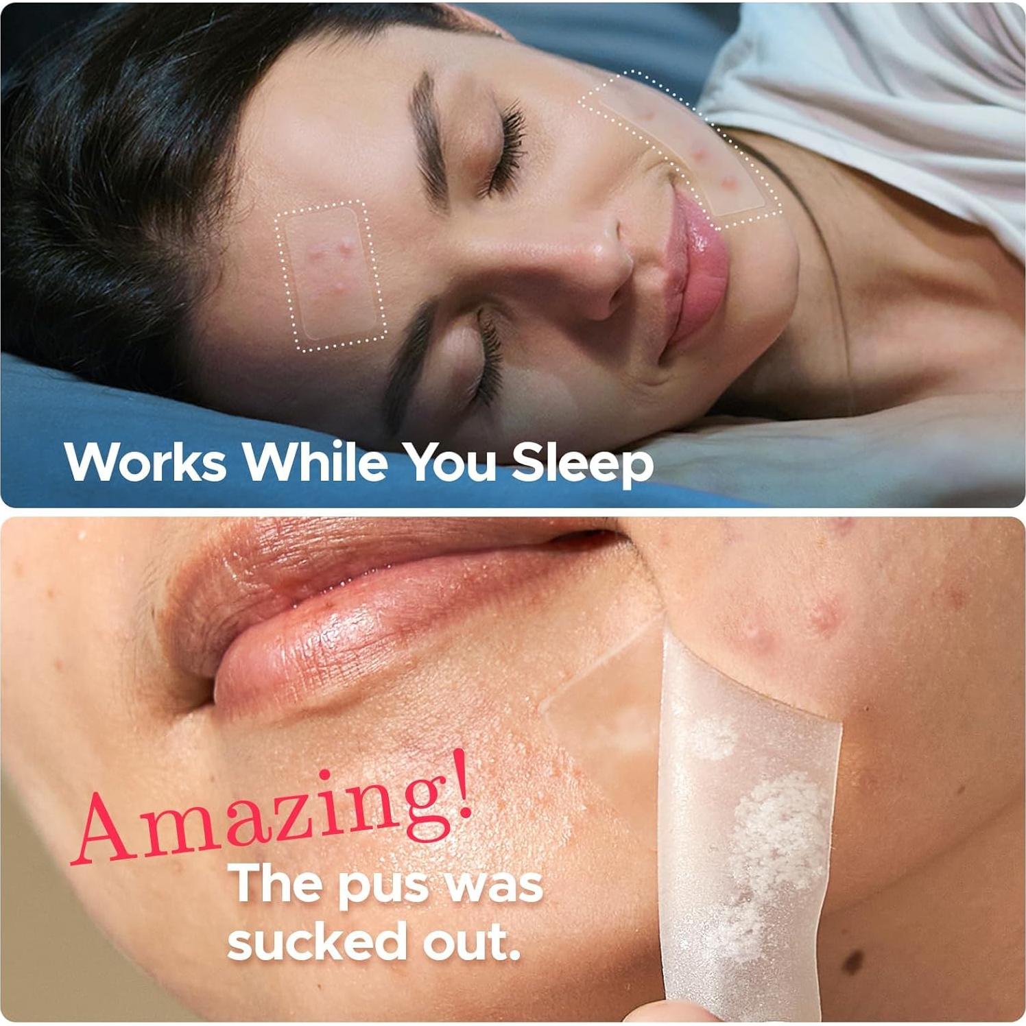 Parche Hidrocoloide para Granos LitBear - 156 Parches, 5 Tamaños