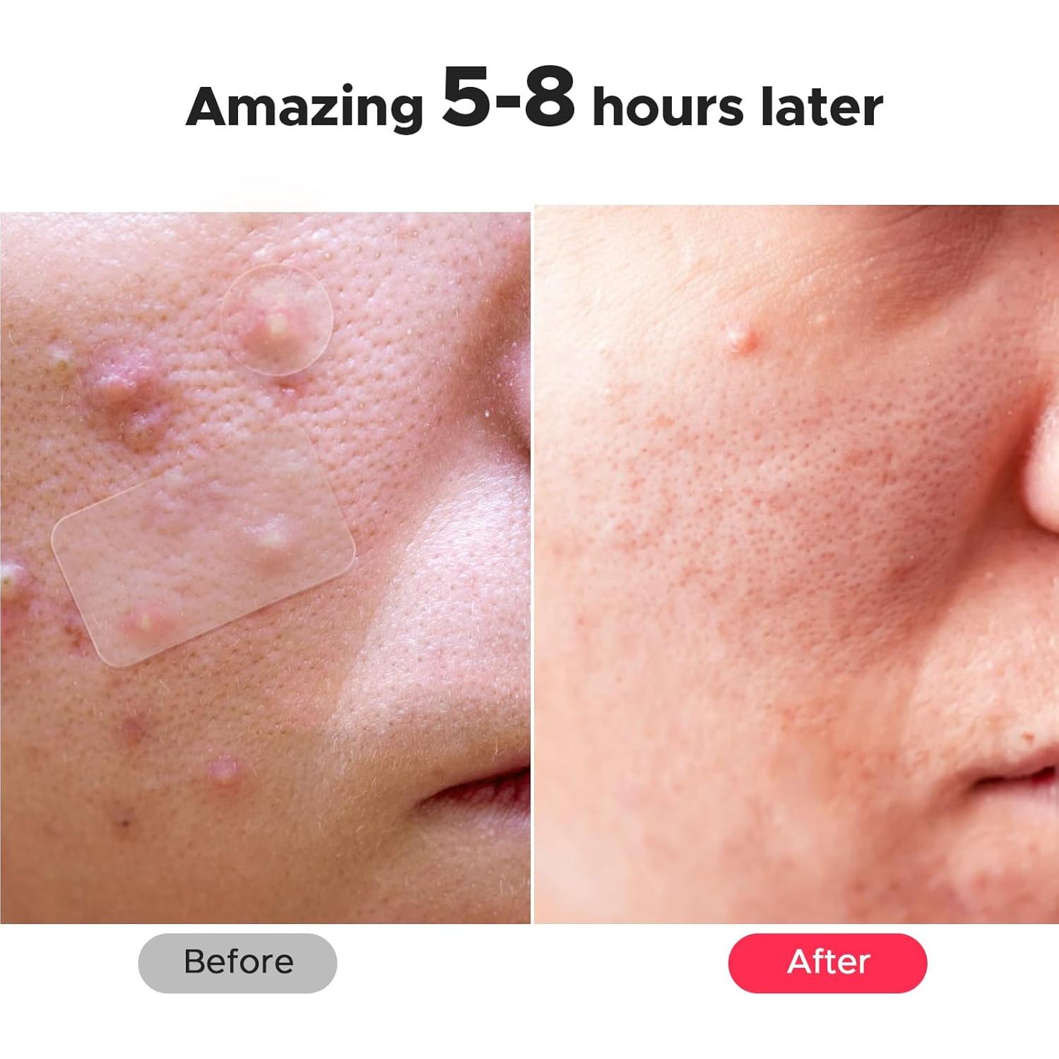 Parche Hidrocoloide para Granos LitBear - 156 Parches, 5 Tamaños